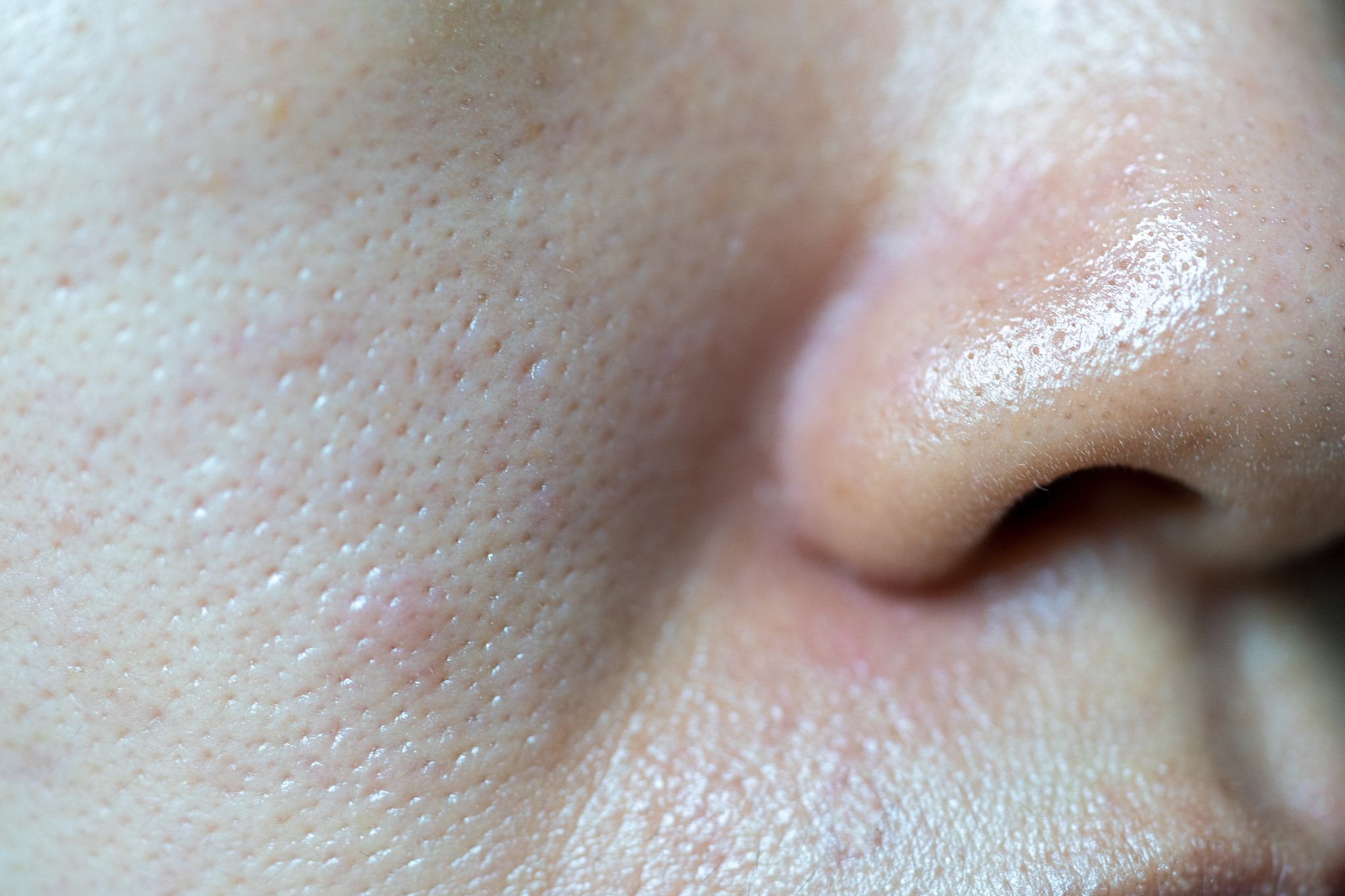 acne blackheads on skin of nose and spot melasma pigmentation on