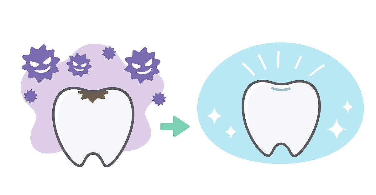饭后不刷牙会蛀牙吗？