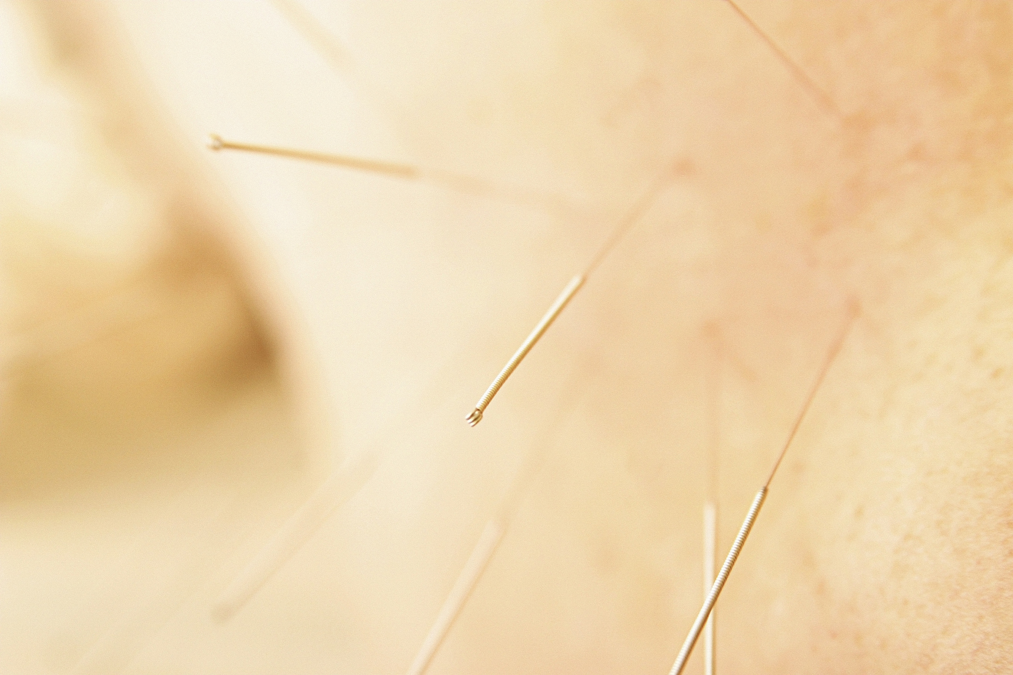 skin with acupuncture needles