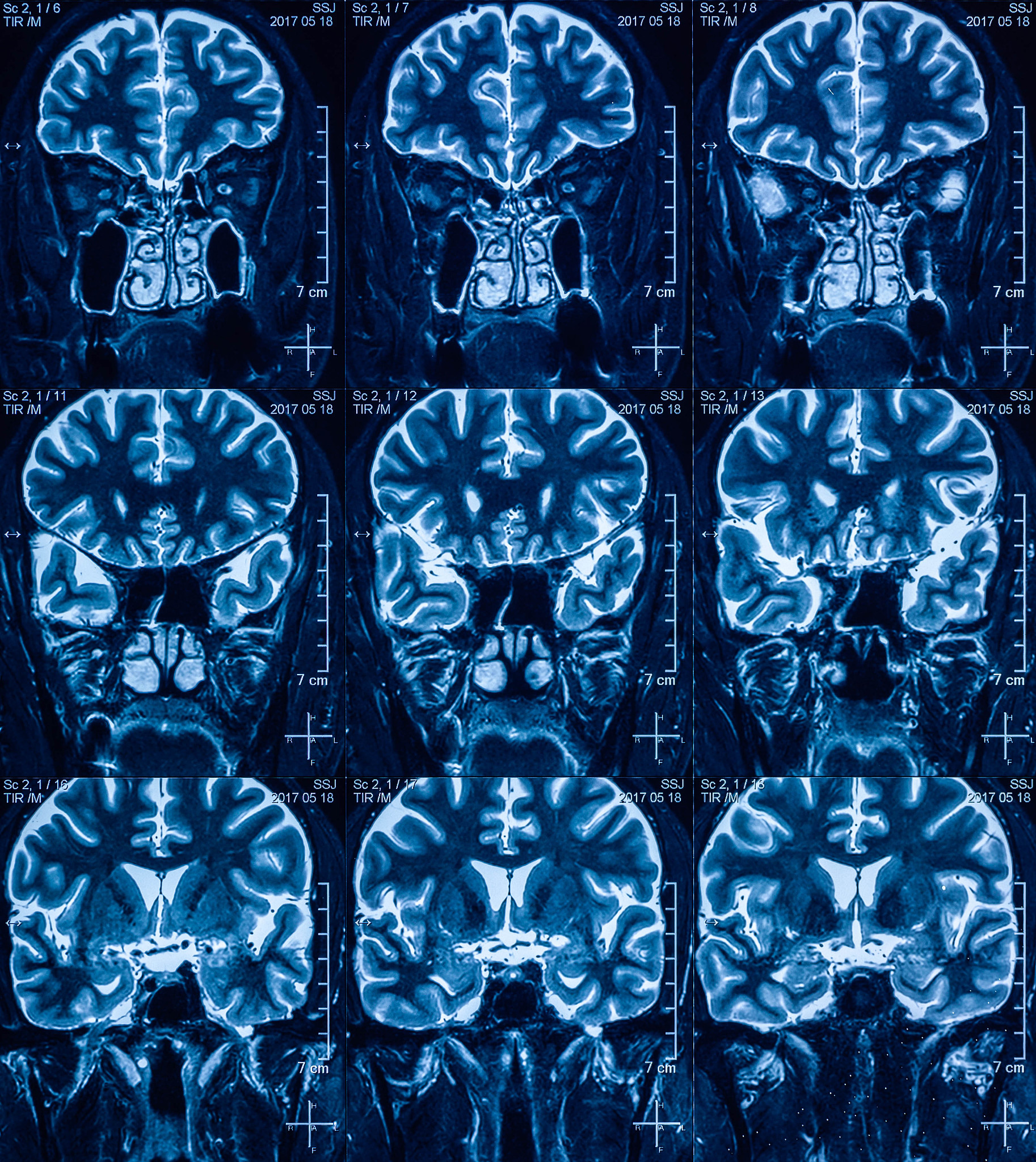 脑脓肿影像特点
