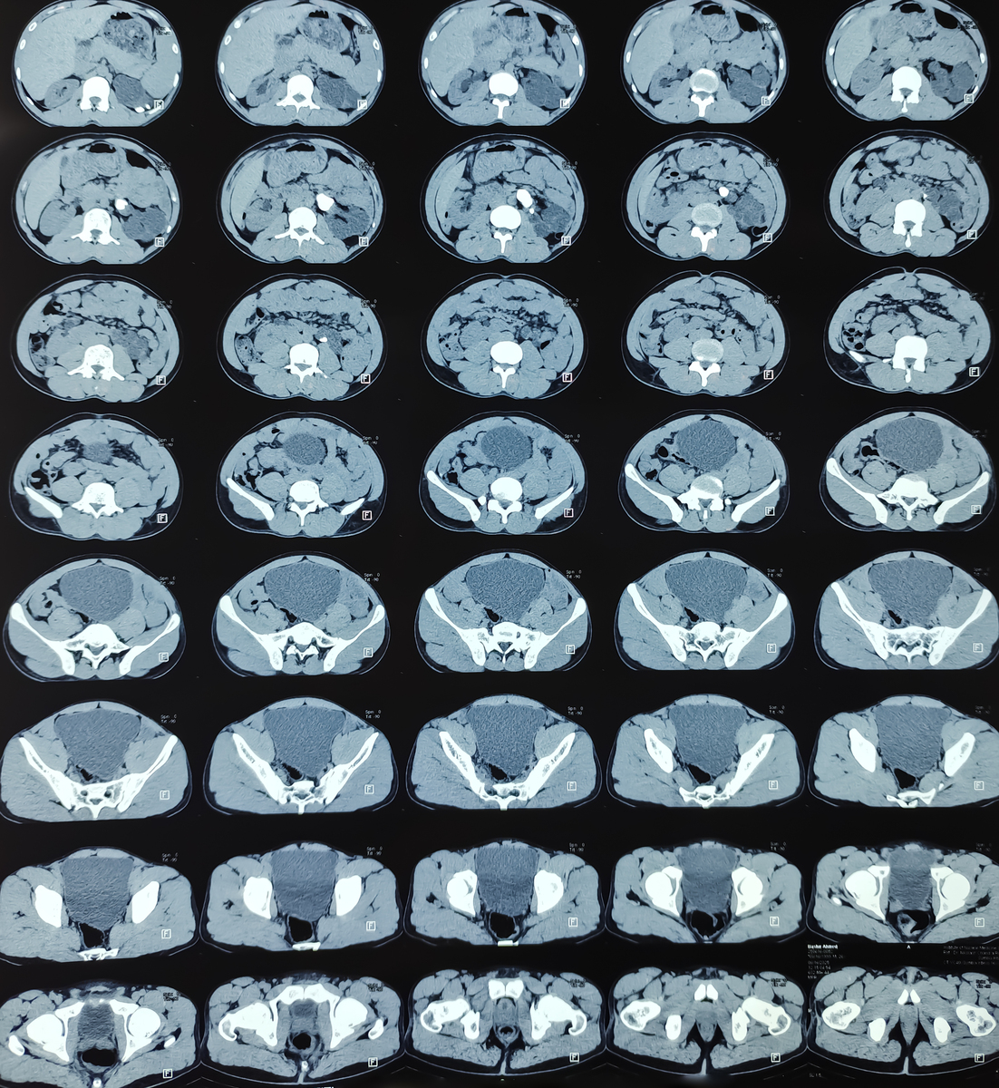 超声造影：更精准显示斑块内新生血管的利器