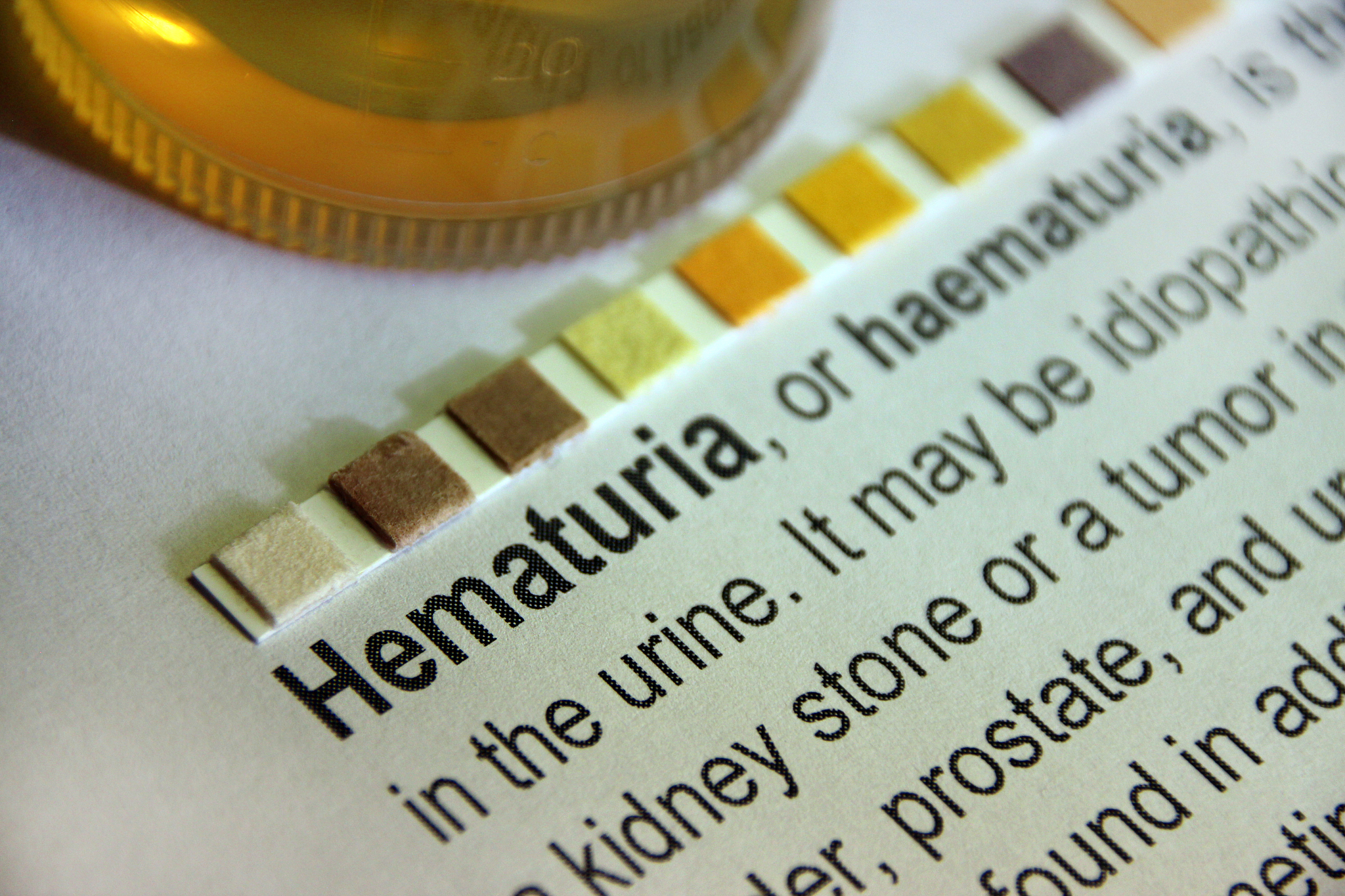 尿酸与肾脏疾病的关系研究如尿酸肾病、肾结石等？