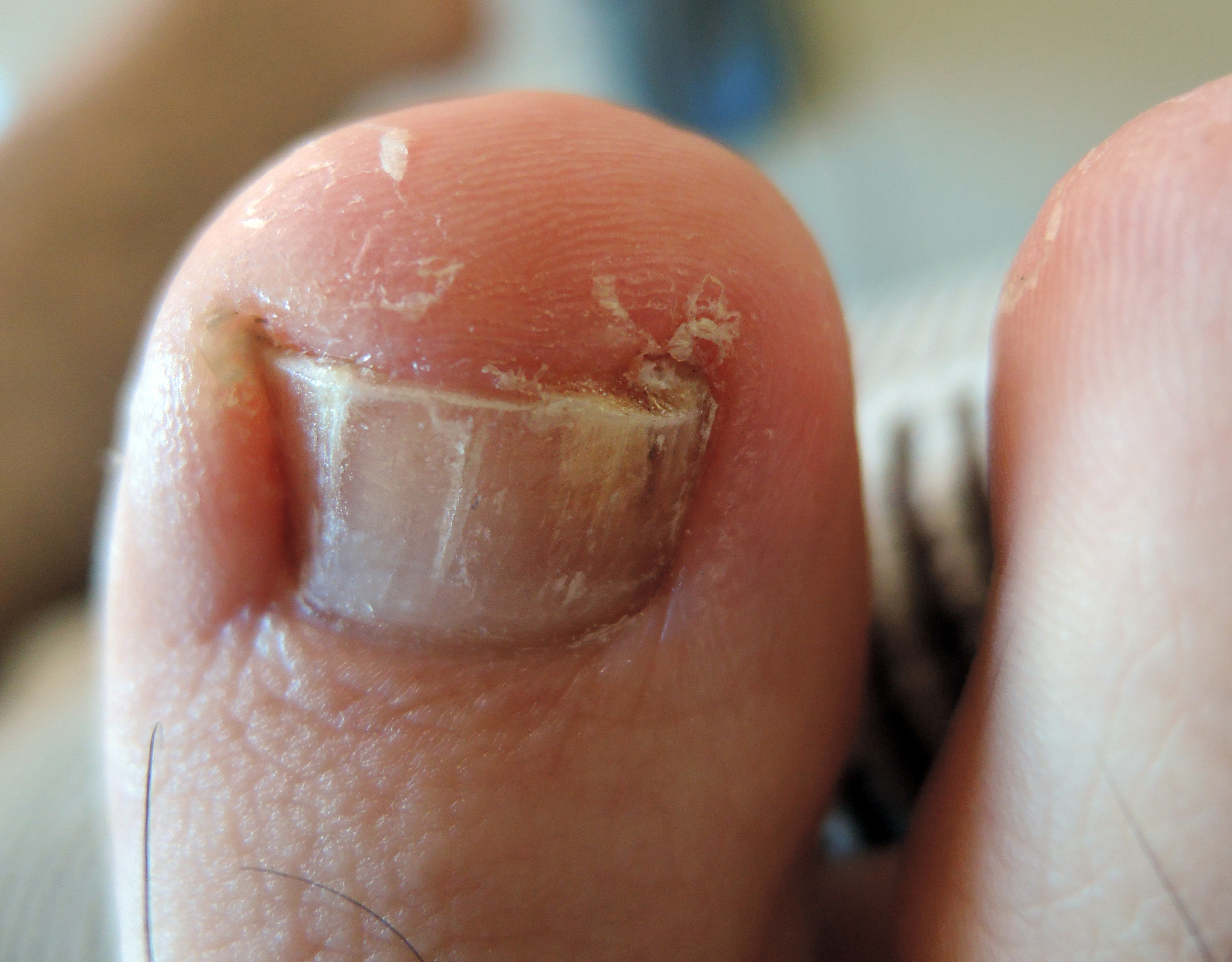 指甲往肉里长怎么办？