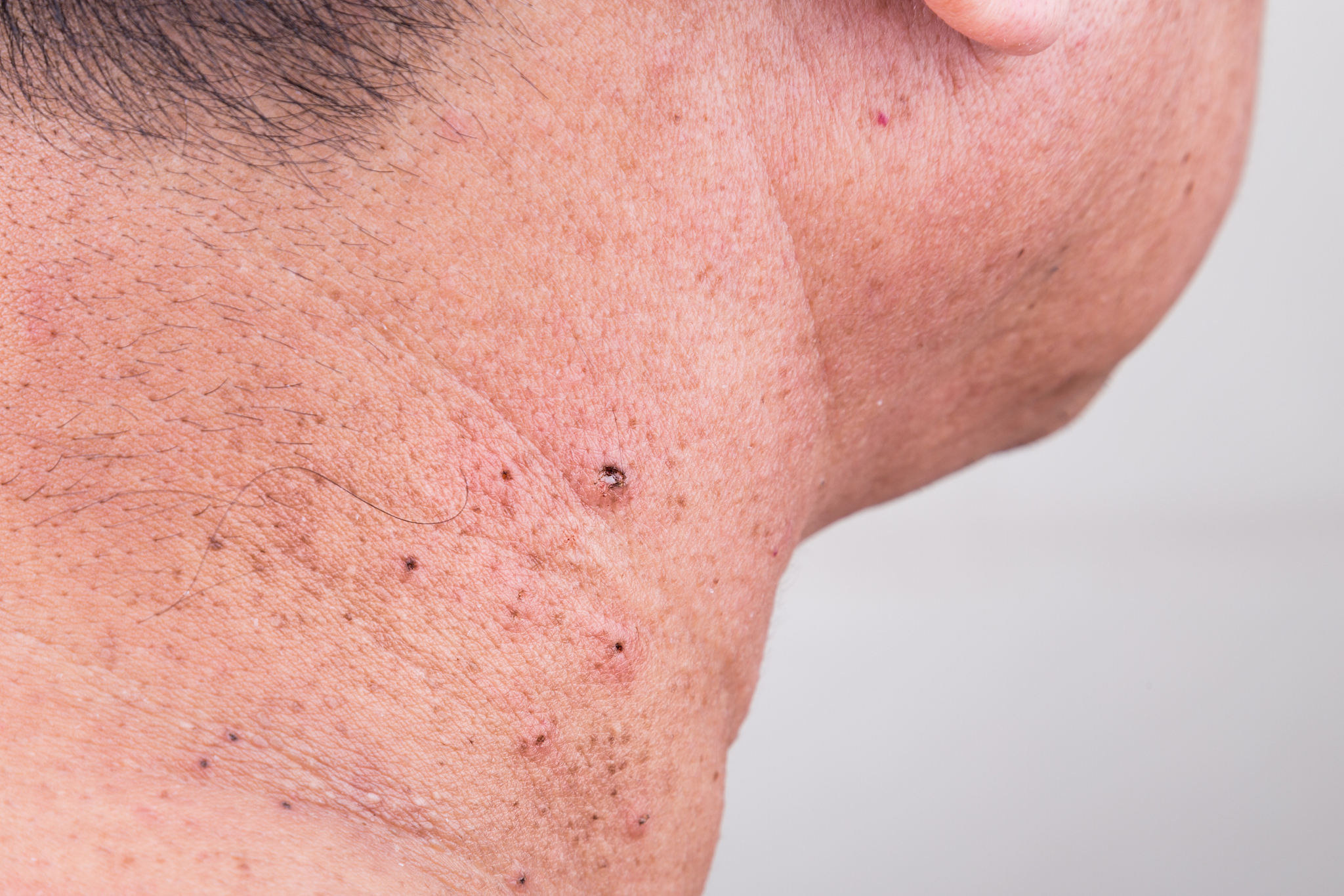 mole removed via skin graft procedure leaving scar