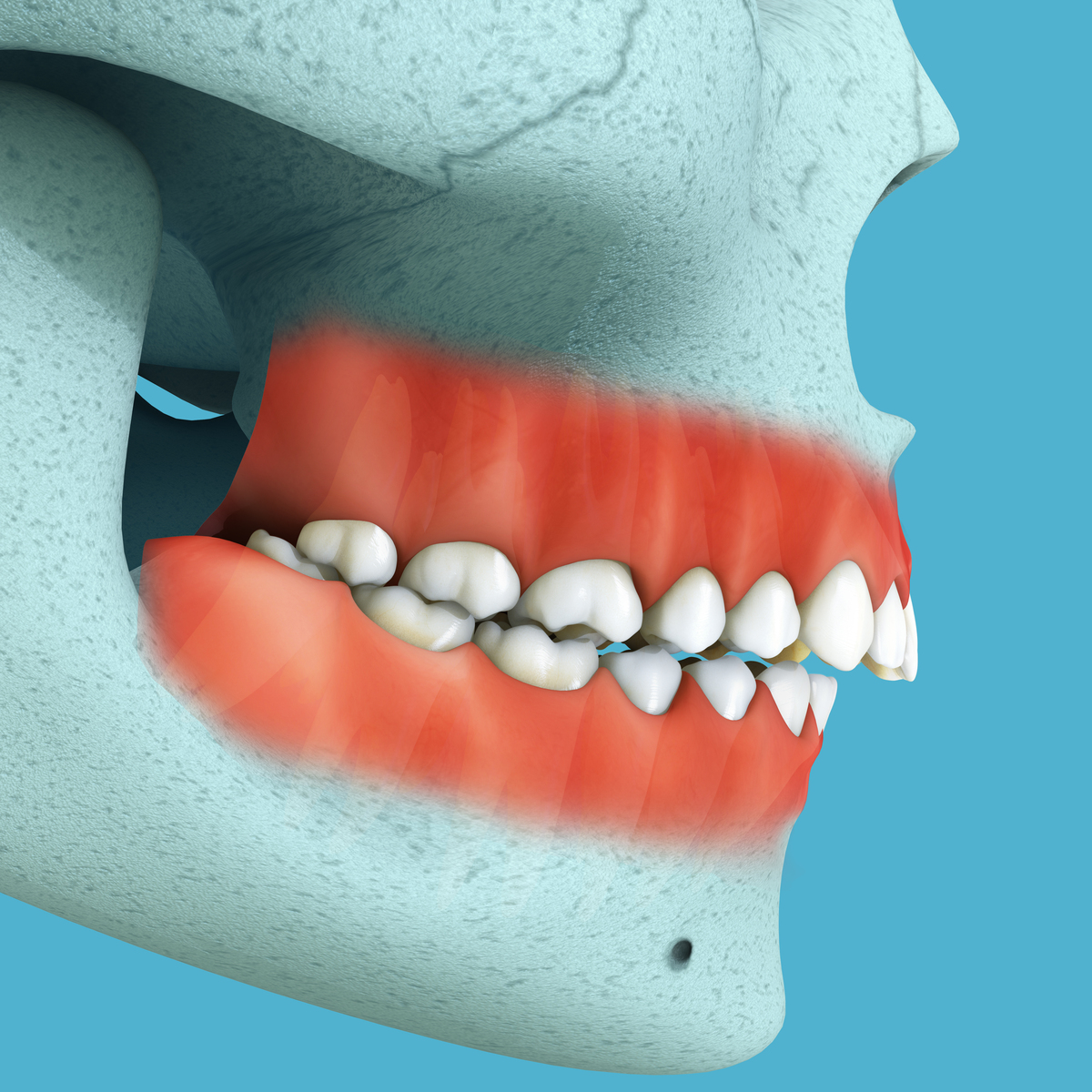 下颌右侧第一臼齿与第二双尖牙之间牙周袋的治疗效果