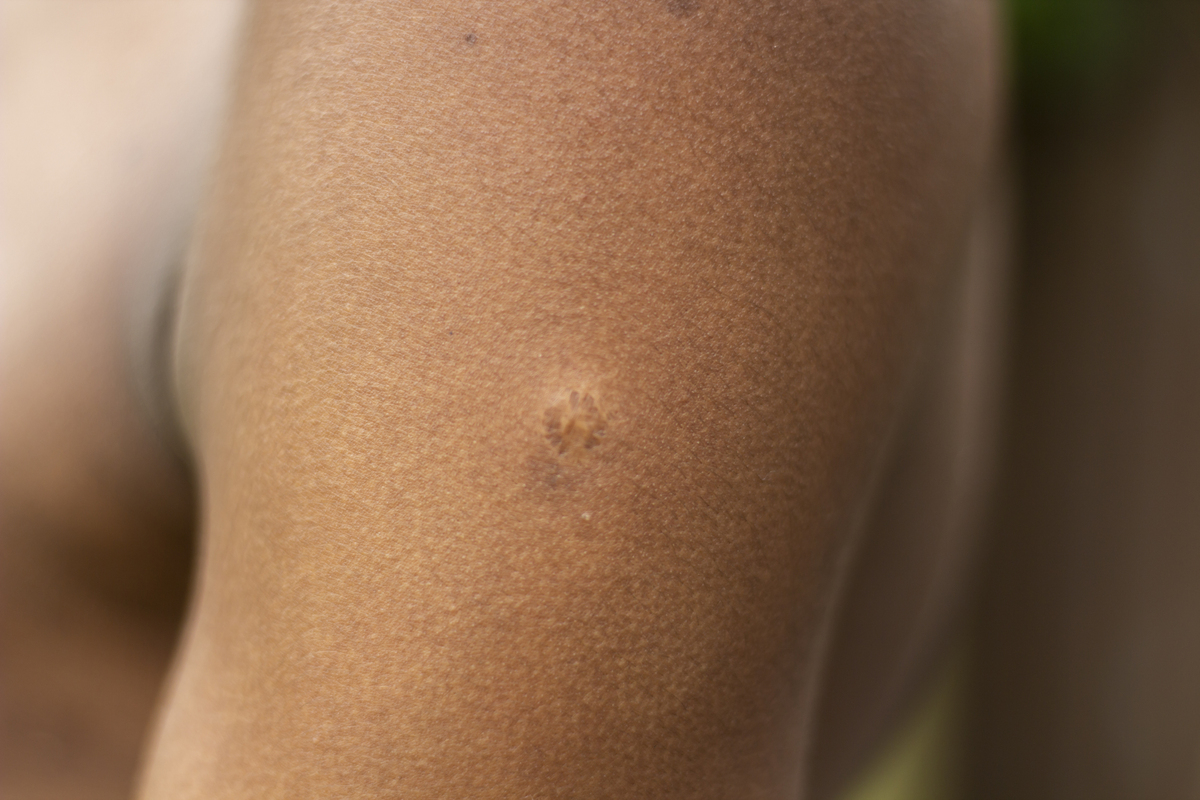 胳膊上毛孔起小点点：可能是毛囊炎或汗管炎！