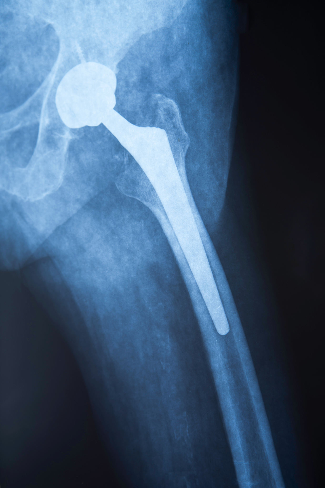 激素性股骨头坏死：了解这种髋关节疾病