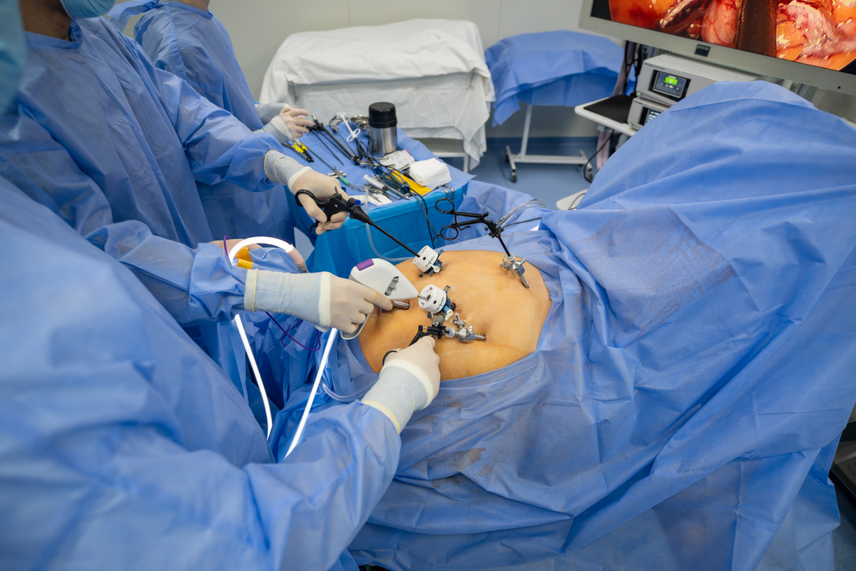 腹腔镜手术：微创治疗多种疾病的有效方法