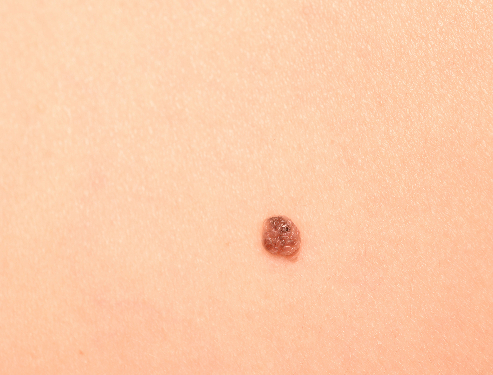 黑斑息肉病在各个年龄段的情况