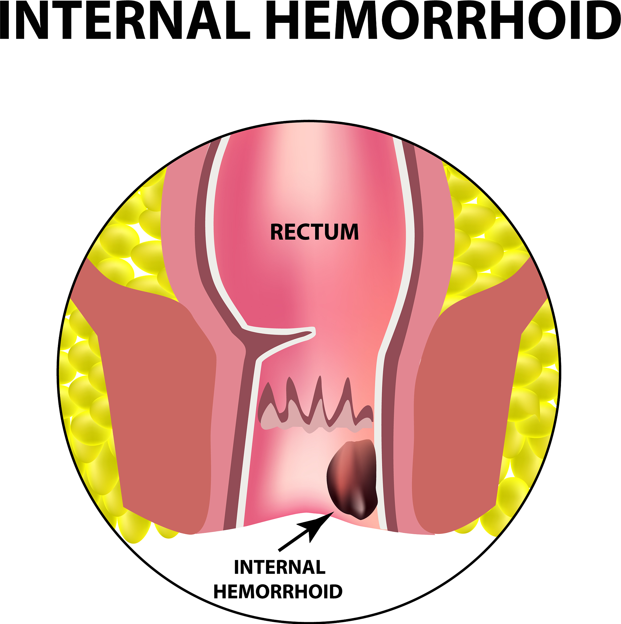 如何防止得痔疮