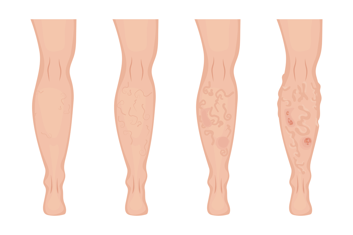 写一个静脉曲张病的预防论文 300字