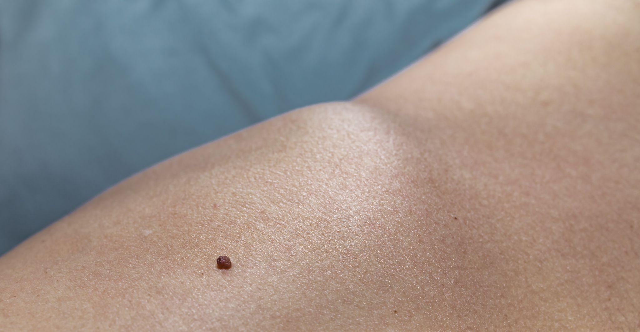 brown raised skin mole