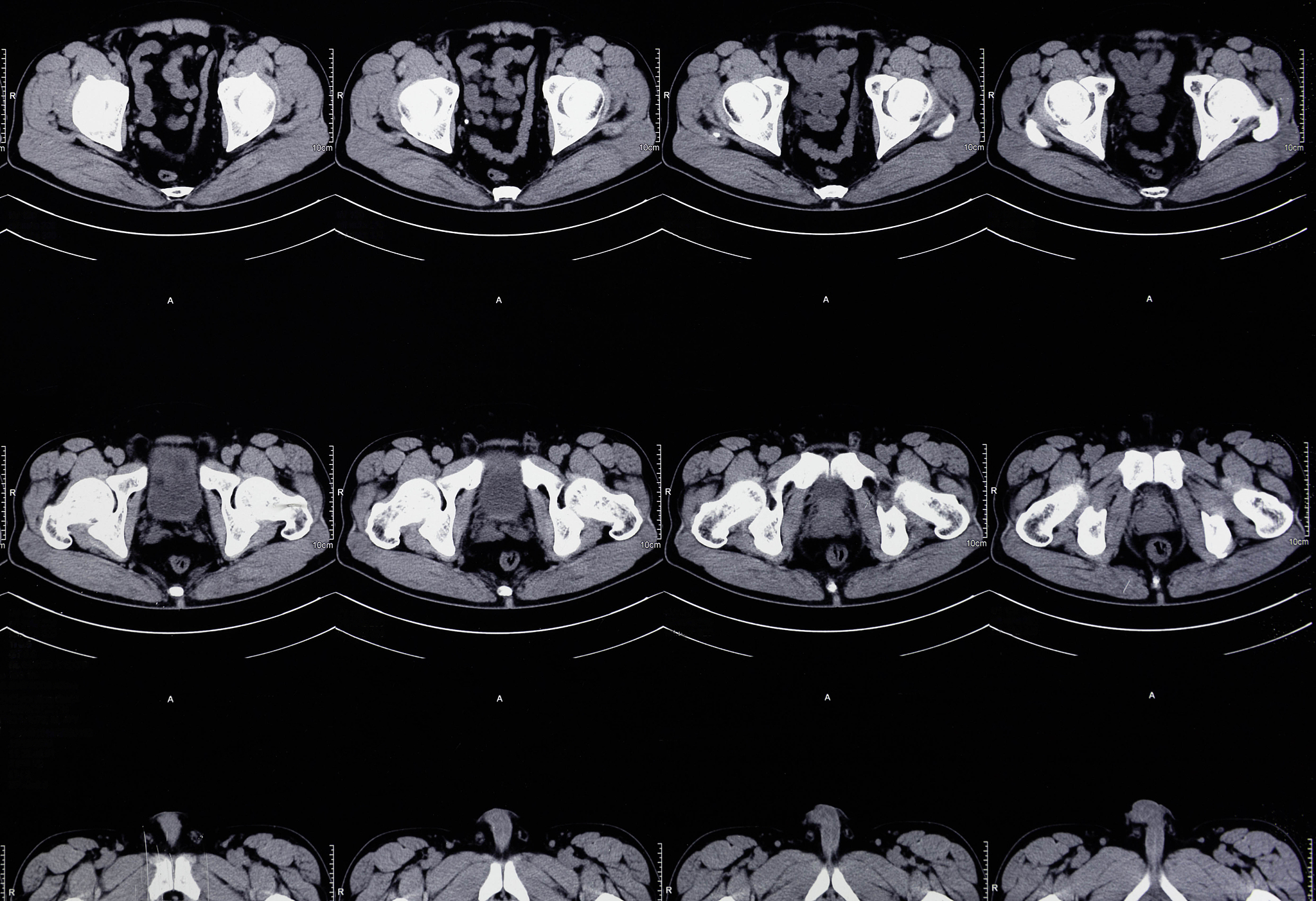 腹部影像学检查在胆囊癌诊断与治疗中的创新应用