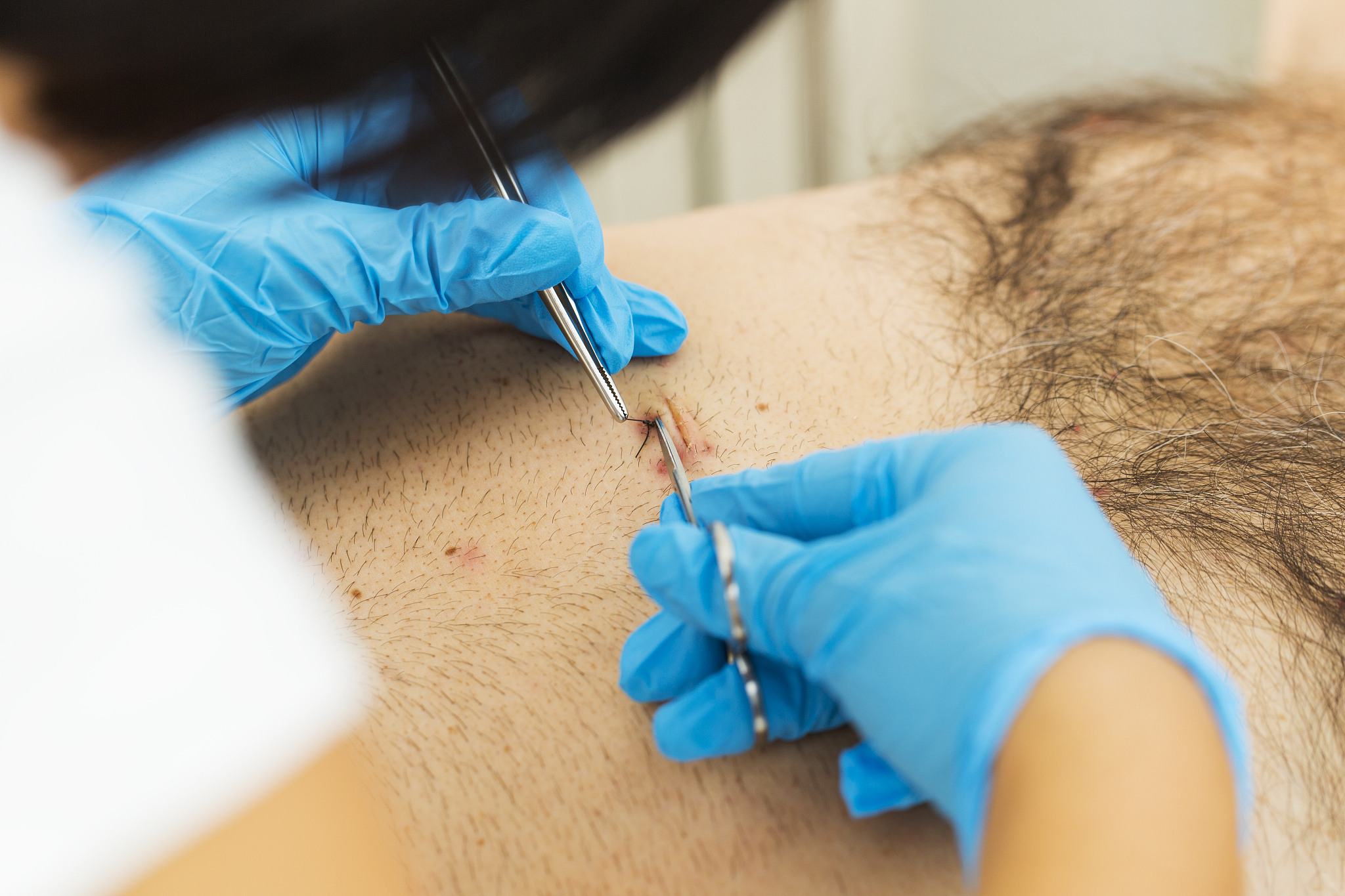 胆囊切除后，我的身体发生了这些惊人变化！