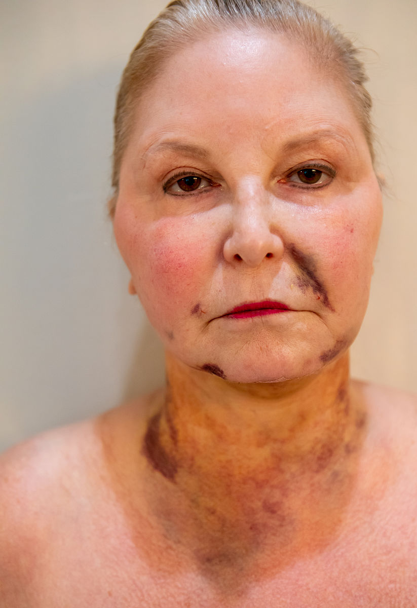 脸黄瘤是什么意思