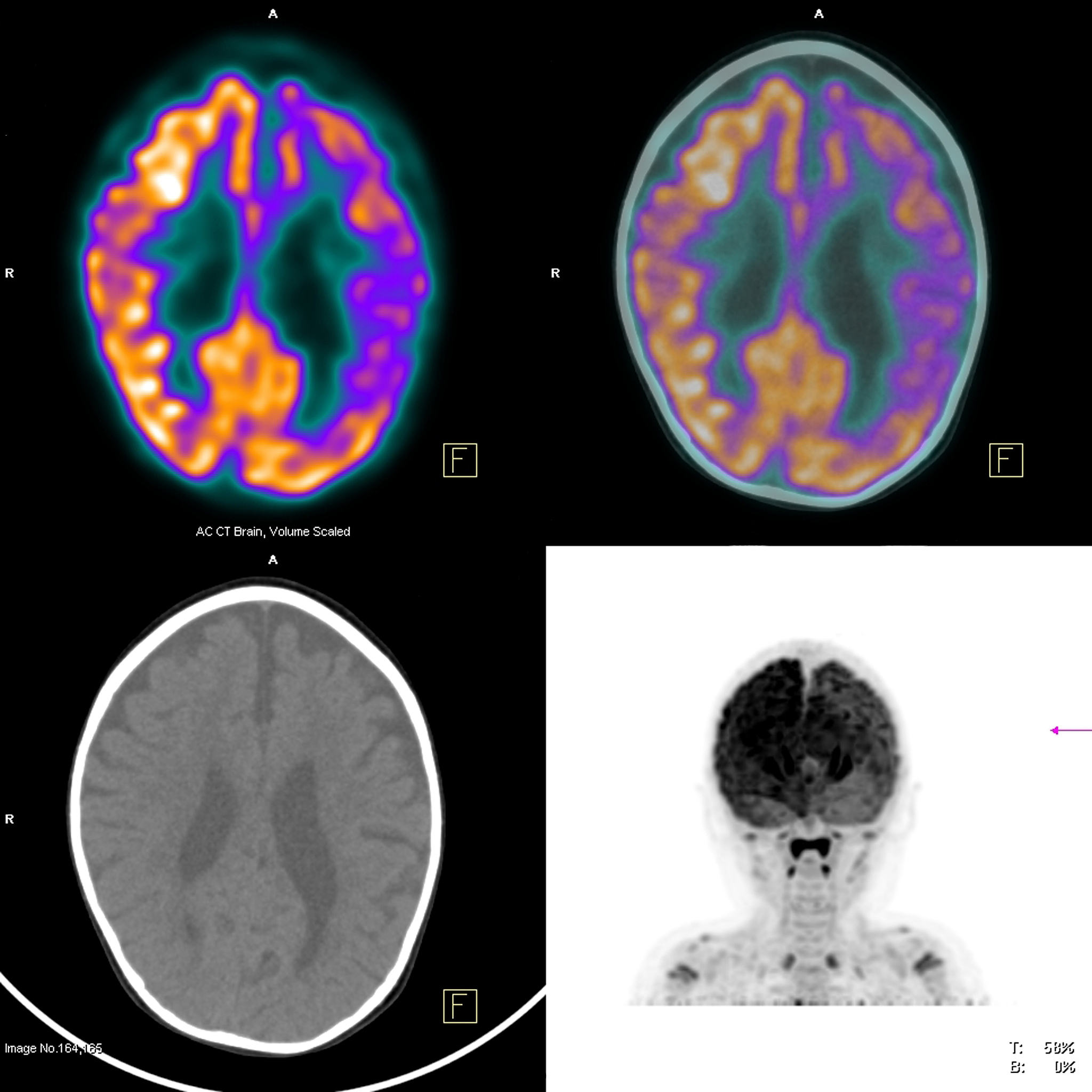 血脑屏障如何阻挡乳腺癌脑转移？