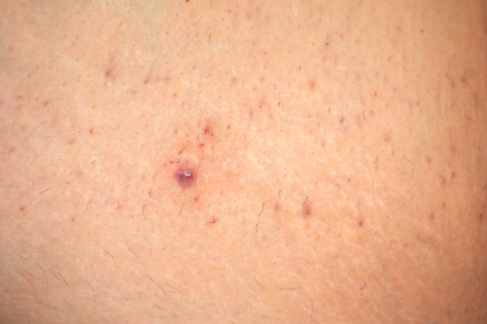 painful folliculitis on female skin