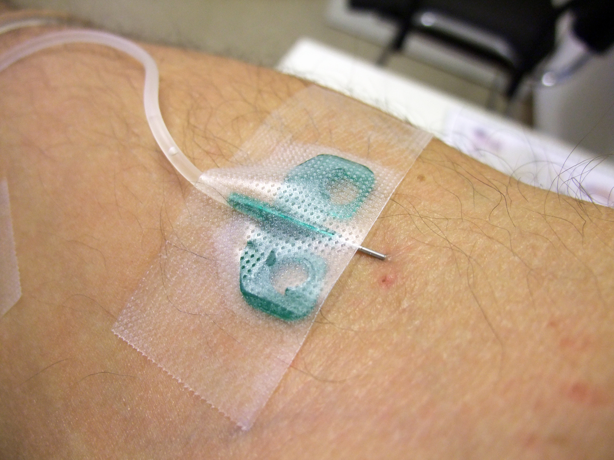 闭合切口负压敷料治疗对血管手术切口感染的影响：一项回顾性前瞻性队列研究