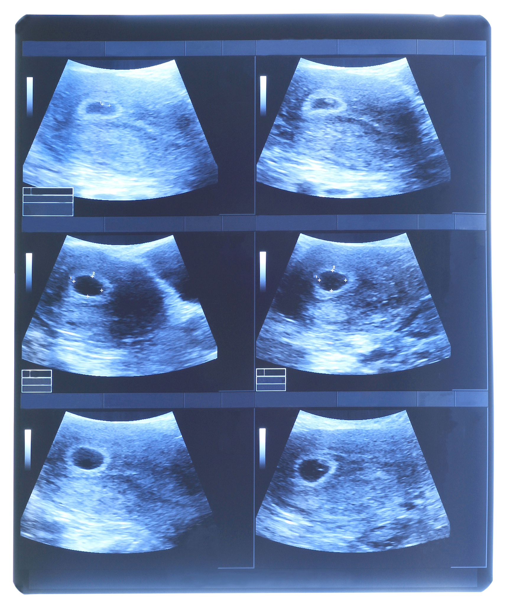 中西医结合治疗宫腔粘连：脐带间充质干细胞调控CXCR4和TGF-β的应用与中医药协同治疗