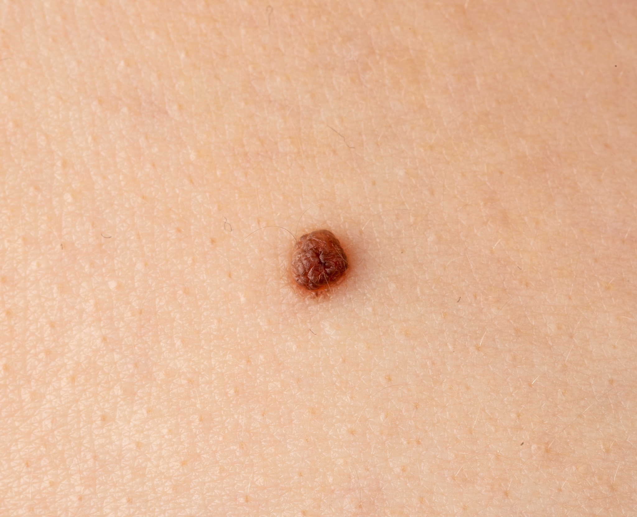 nevus on human skin close-up