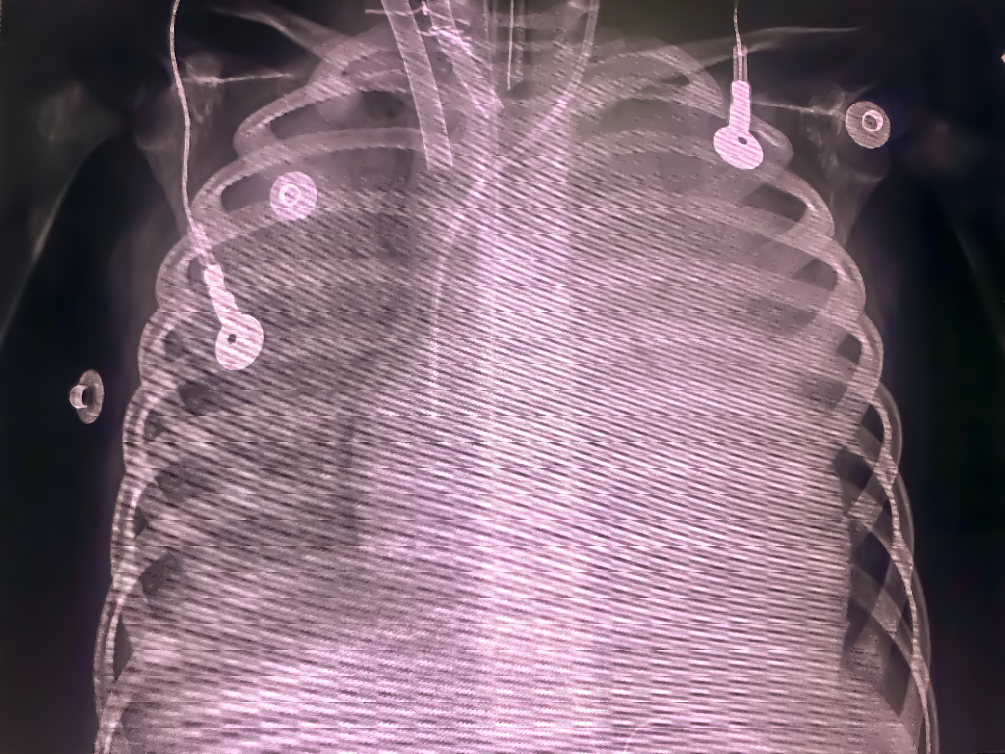 闭合性胸腹部损伤合并创伤性脾破裂腹腔镜探查术中护理要点