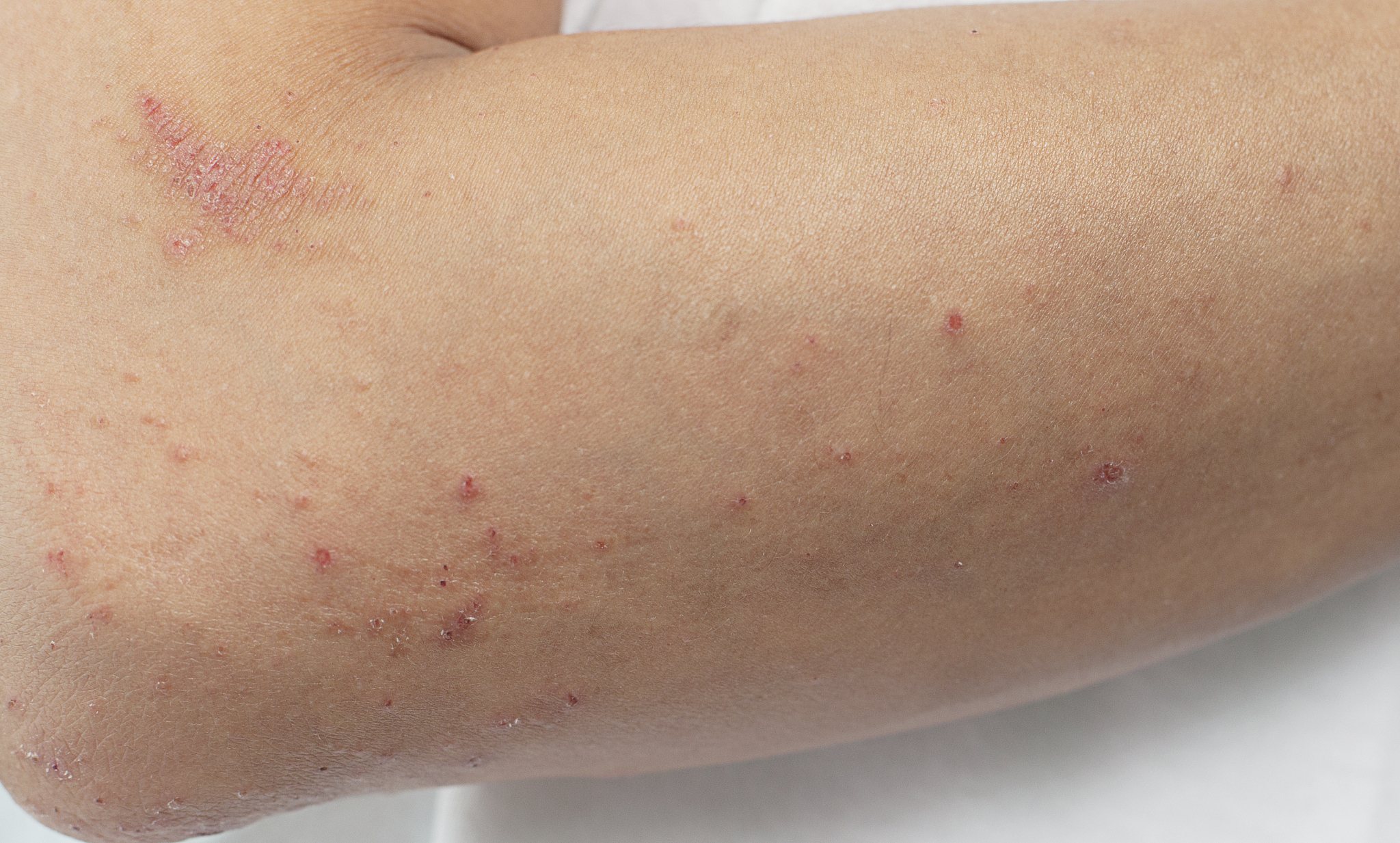 itchy skin lesions from allergies, skin women.