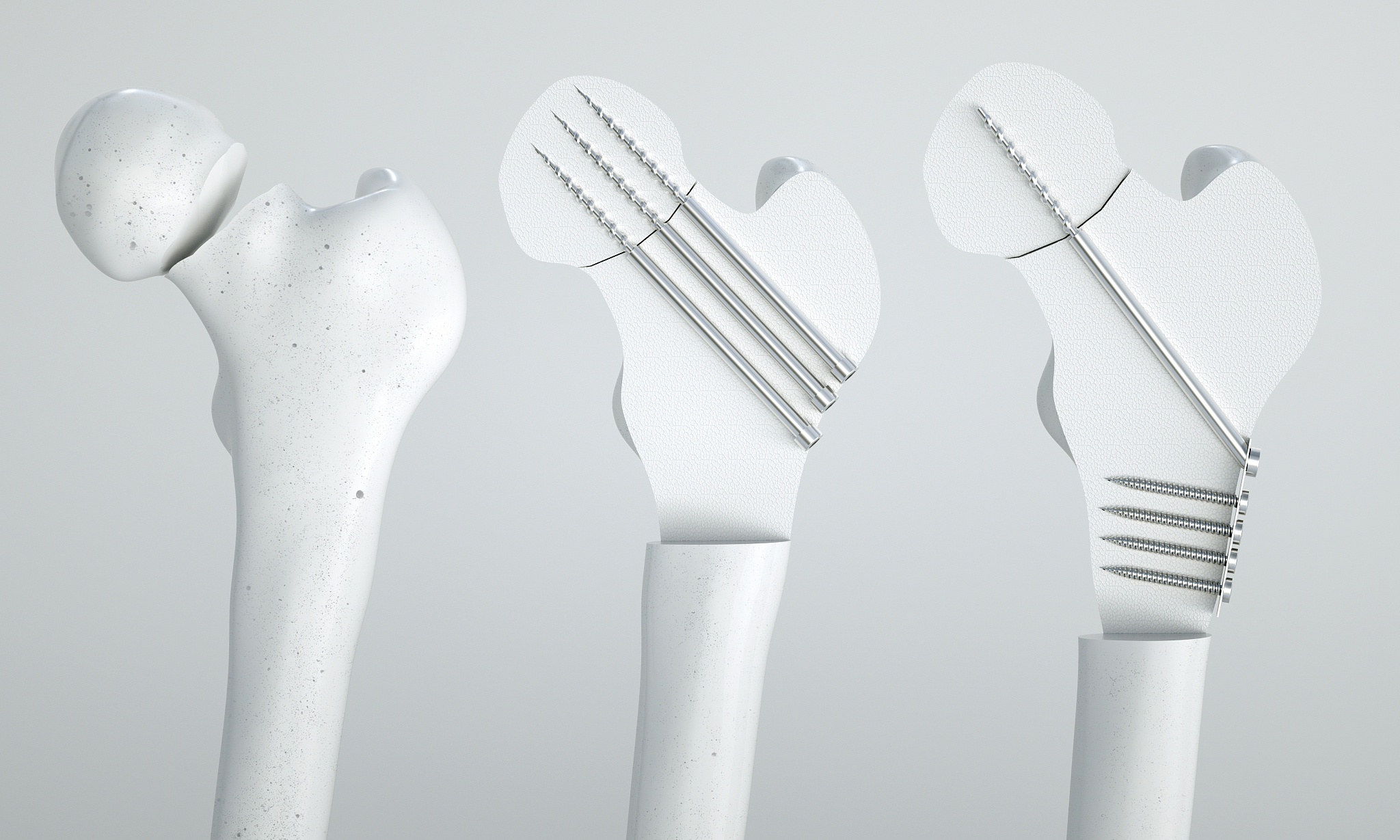 老年股骨粗隆间骨折手术：术前手术室及药物准备指南