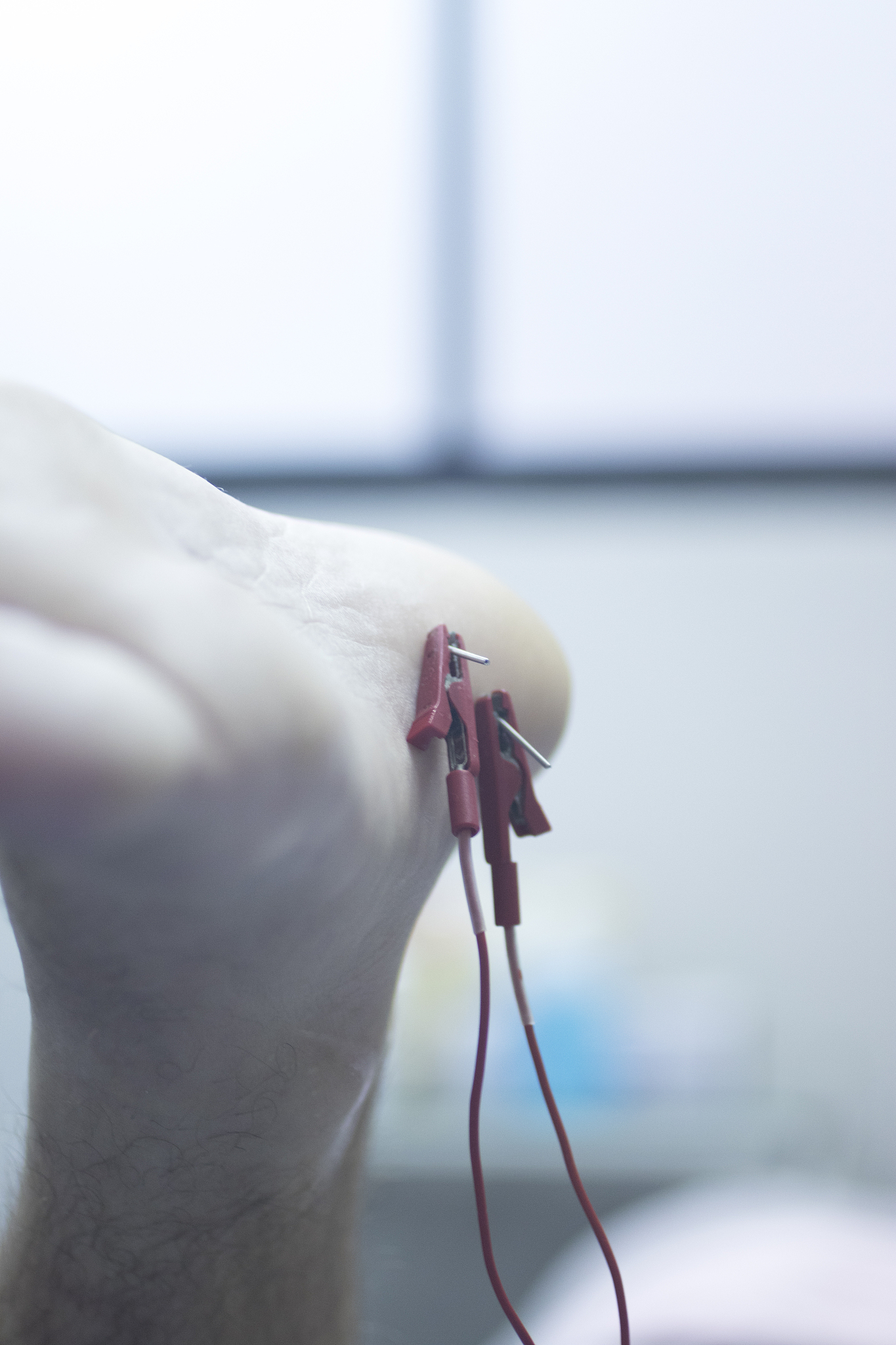 close-up of acupuncture needles in leg