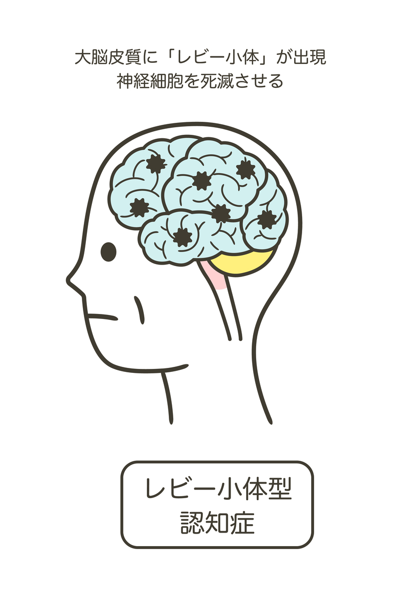 人的多巴胺少了会怎样