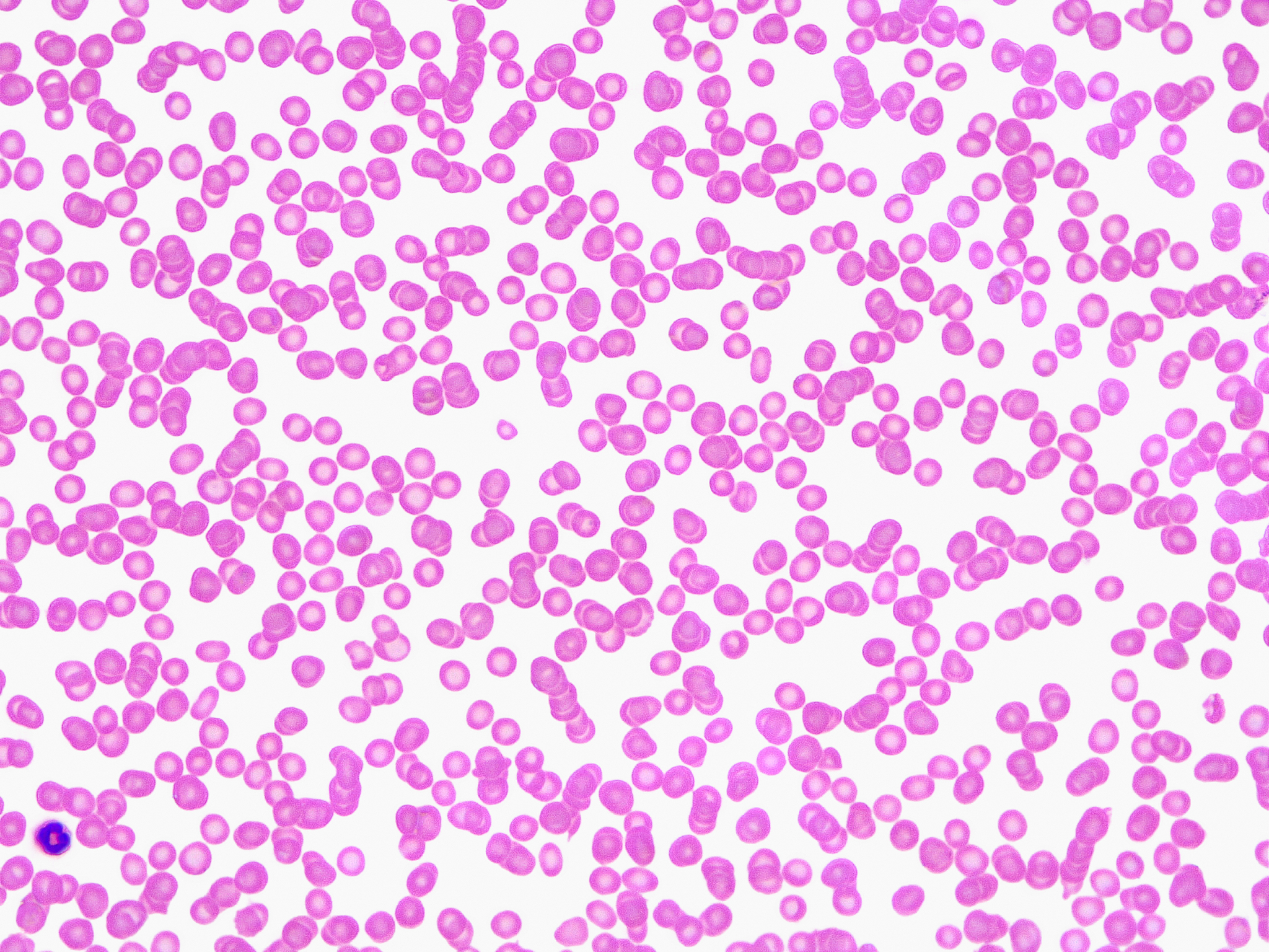 医学检验中血液细胞检验的质量控制影响因素