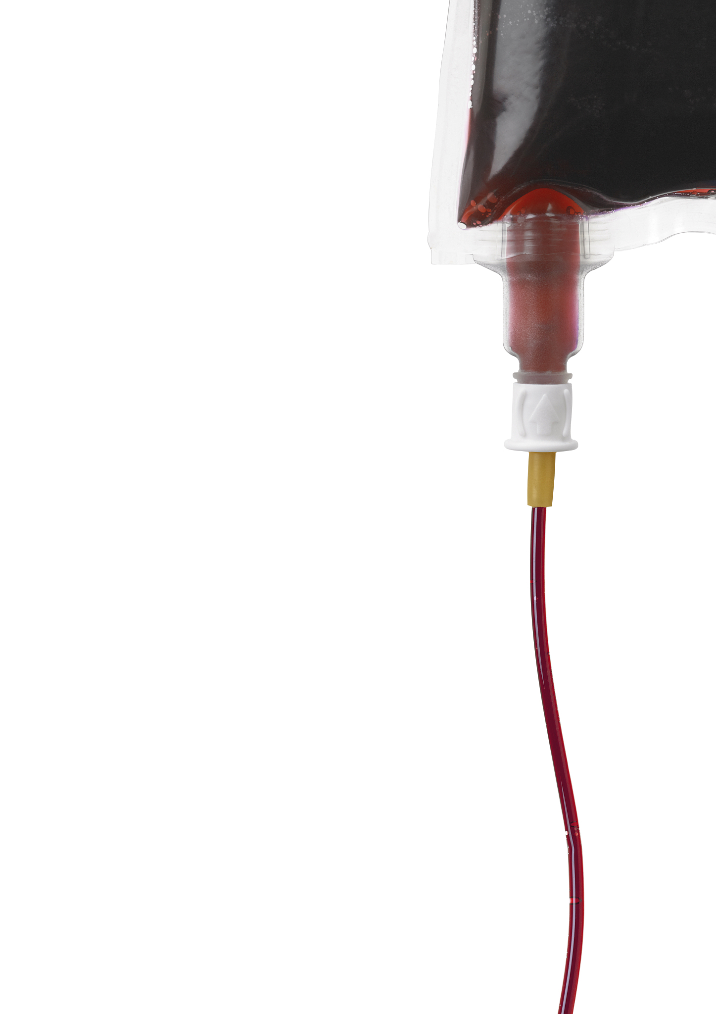 PTA治疗维持性血液透析患者动静脉内瘘狭窄的护理要点