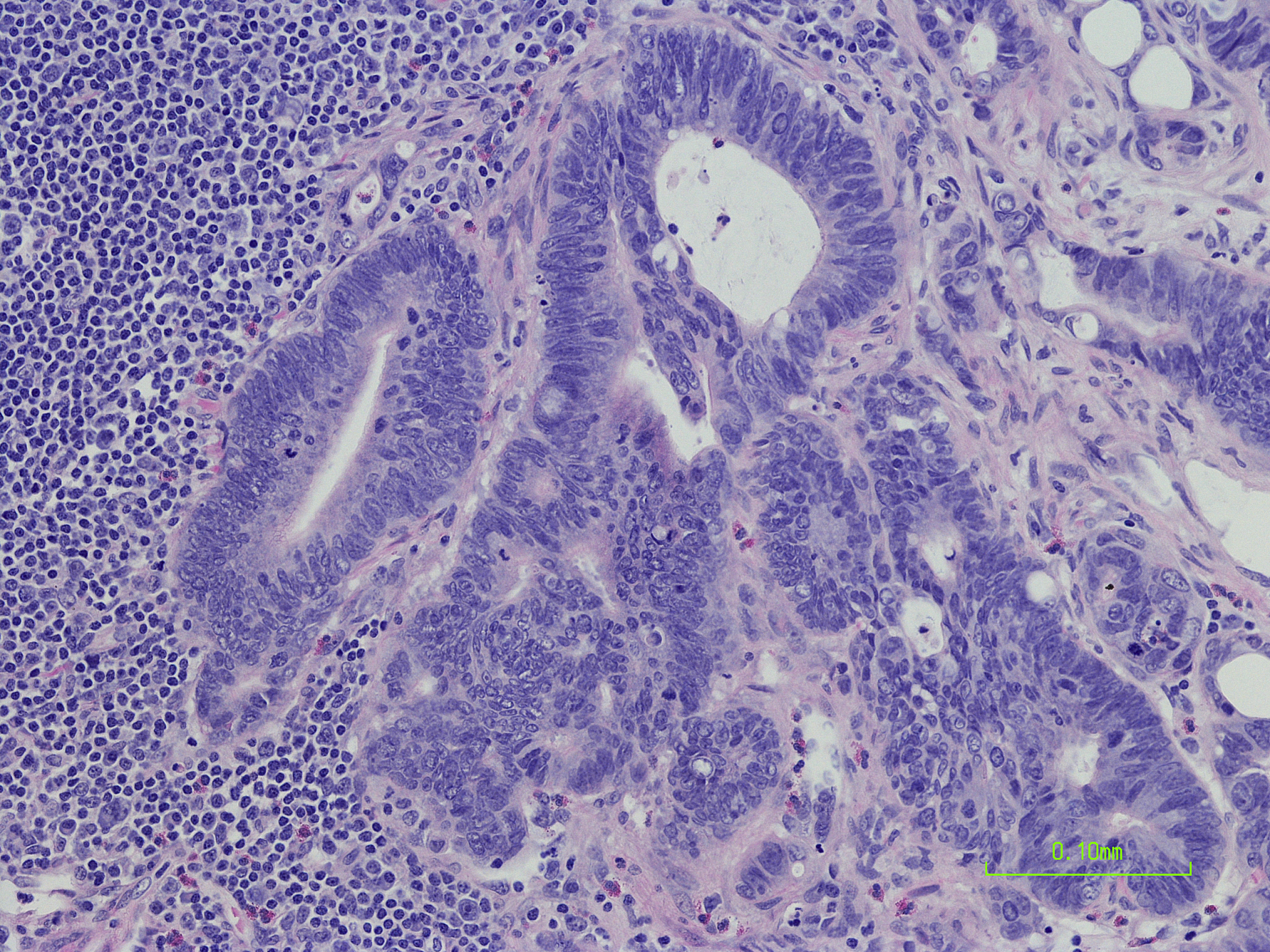 结直肠癌肝转移患者临床试验纳入标准 - 符合条件的年龄范围：从18岁到75岁