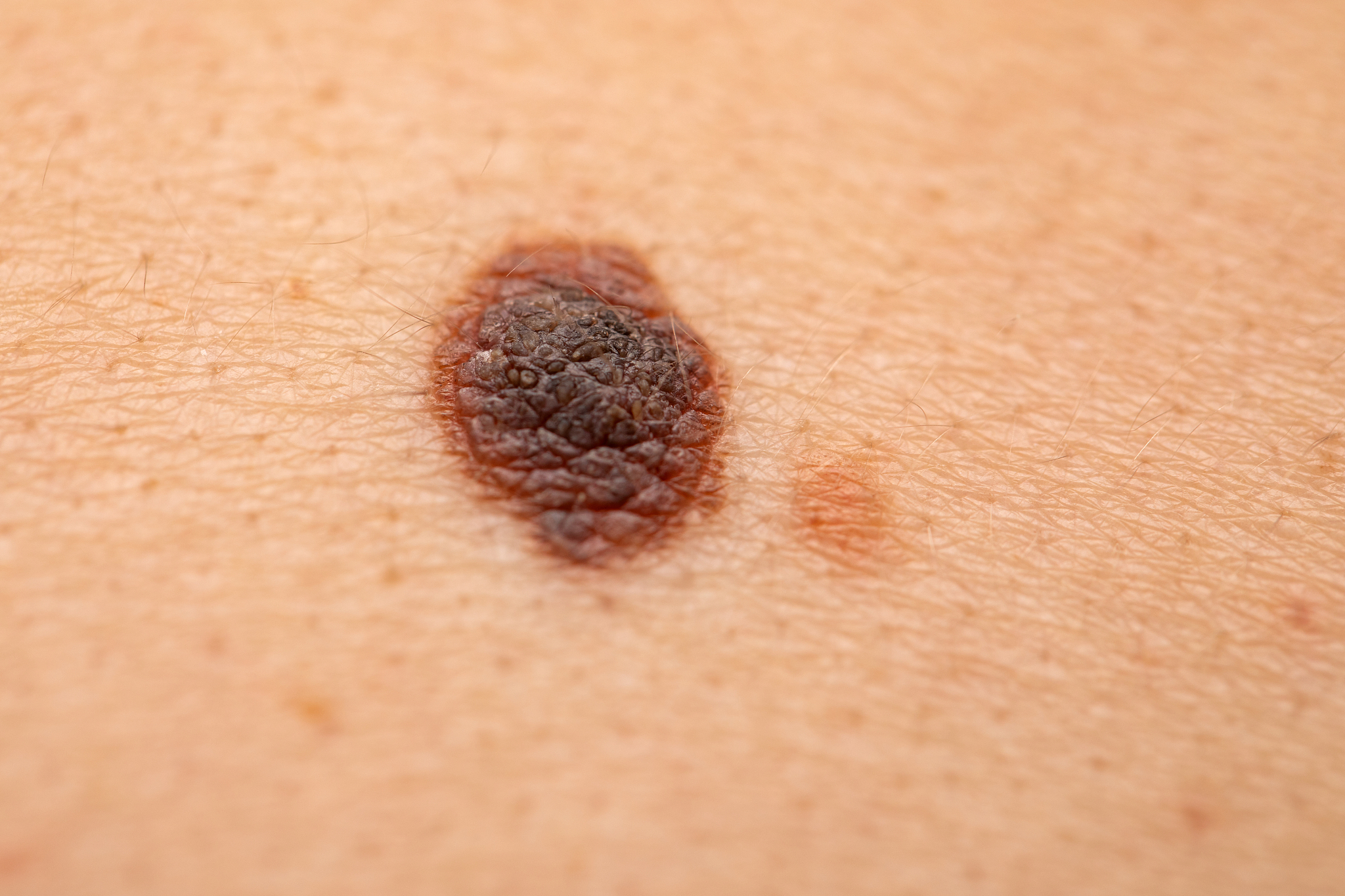 dangerous nevus on skin - melanoma