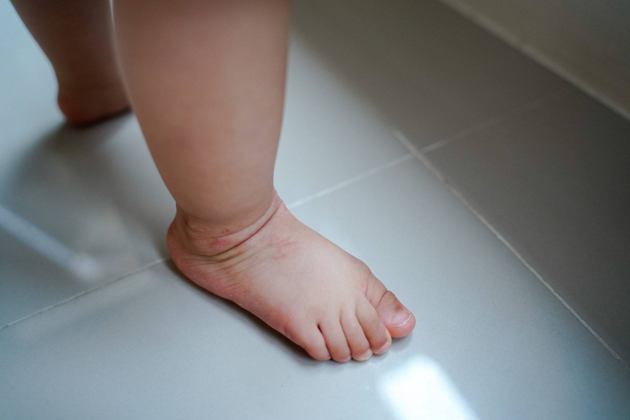 婴幼儿湿疹如何护理？