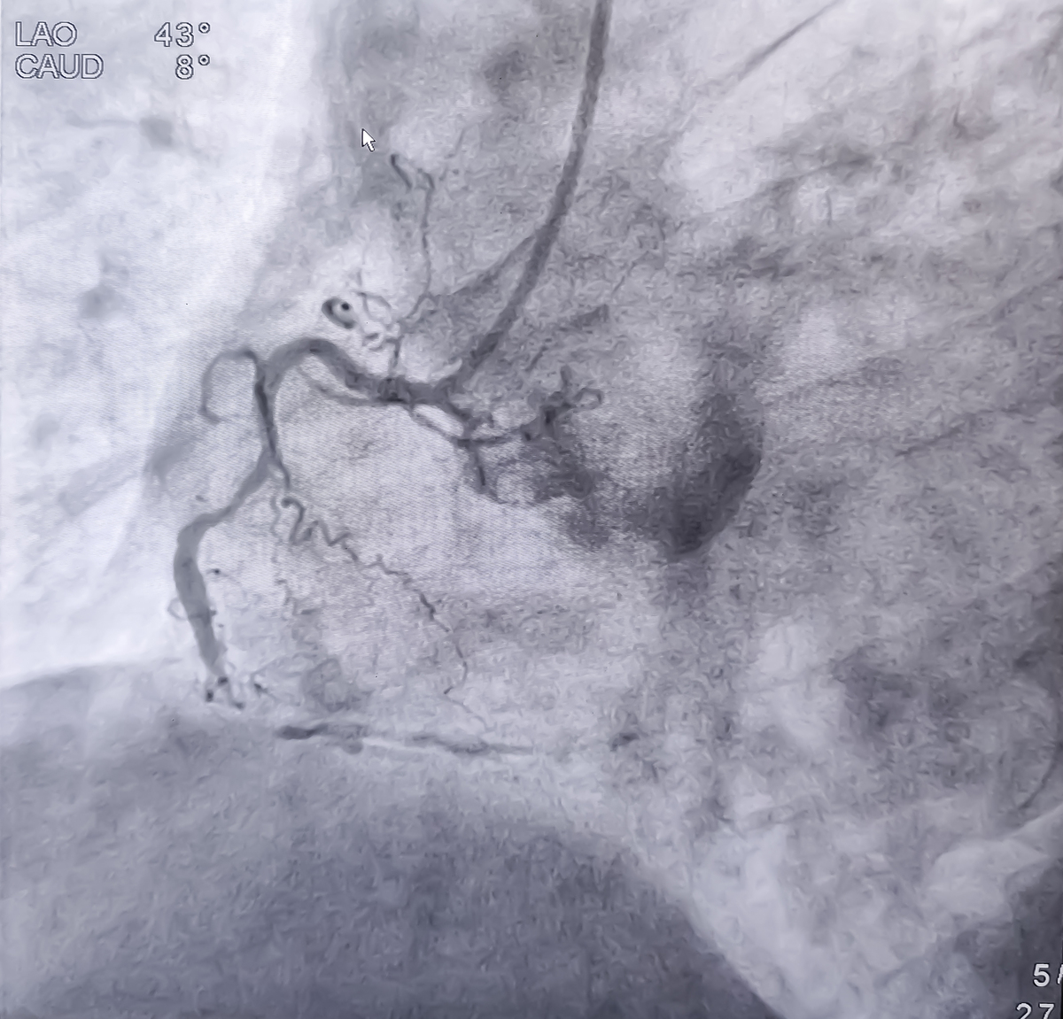 右侧颈动脉易损斑块破裂并血栓形成：超声造影检查结果