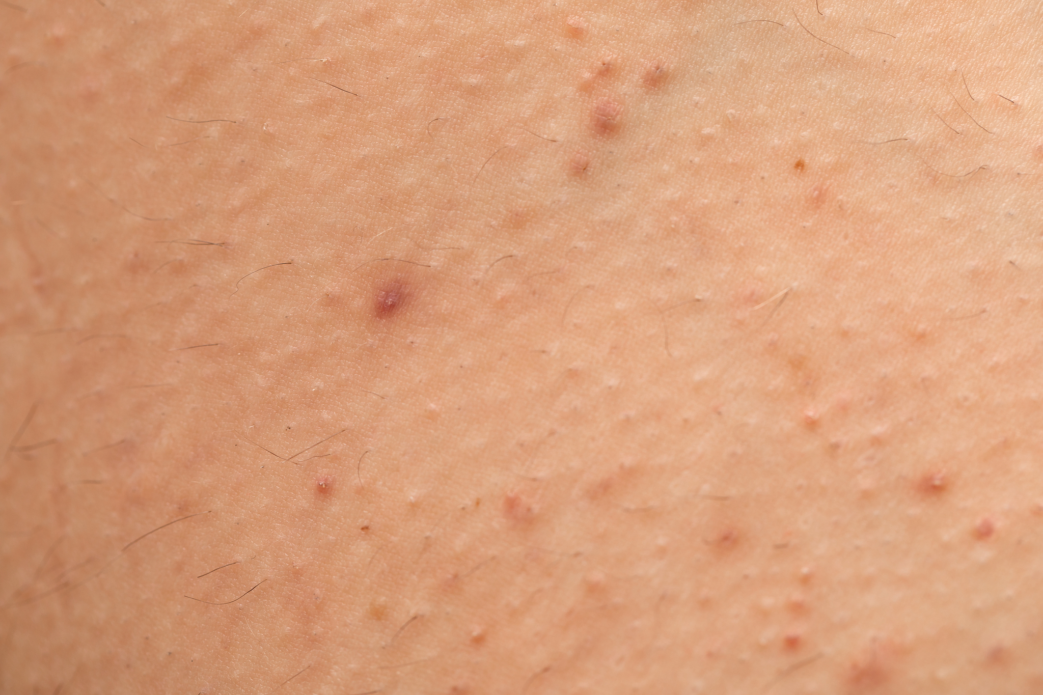 folliculitis on skin - hormonal imbalance