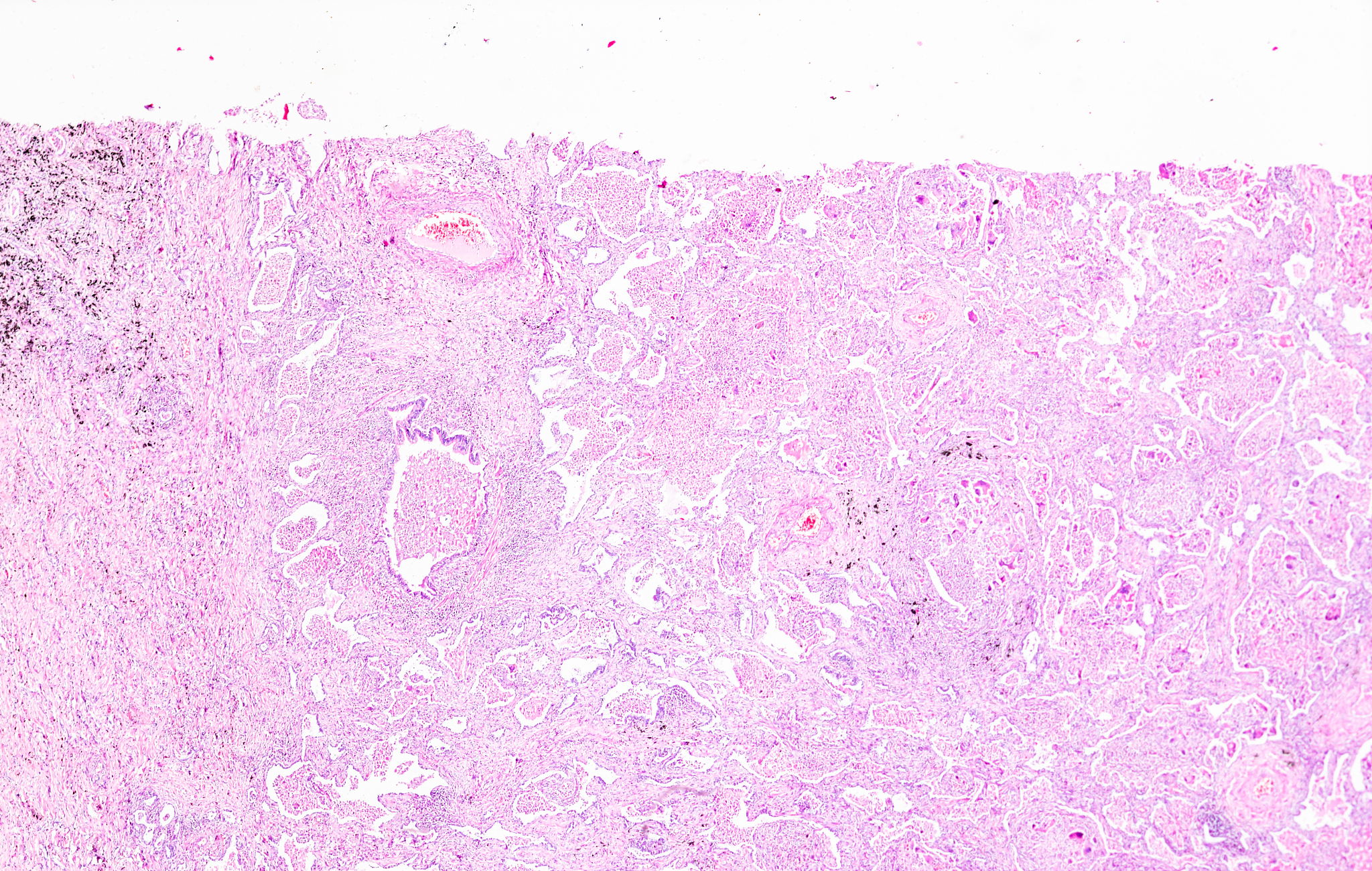 翻译：Granulomatous inﬂammation consists of nodular aggregates of epithelioid histiocytes mixed with a polymorphous inﬂammatory inﬁltrate with or without coagulative necrosis In isolation granulomas are