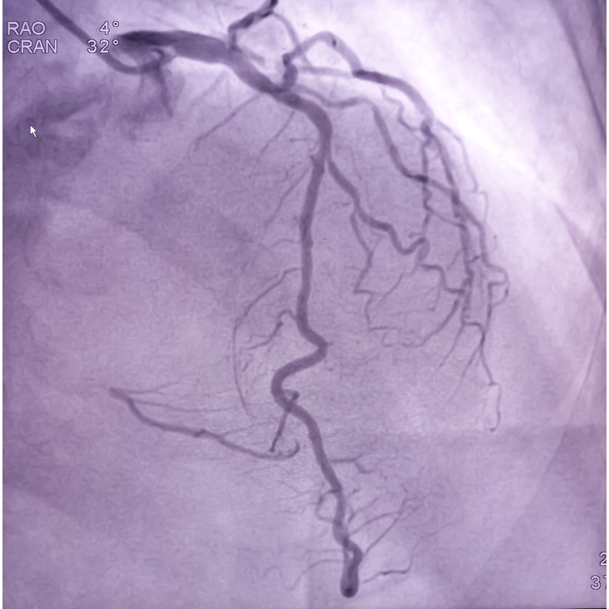 颈动脉斑块破裂导致中风：CTA和DSA诊断评估