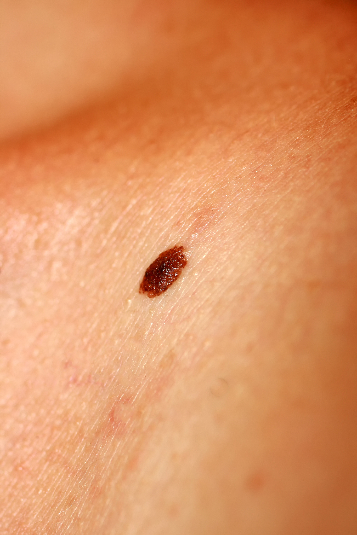 brown birthmark. brown mole large size. stain on the skin