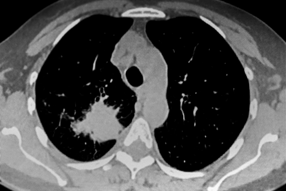 肺部堵塞症状图片