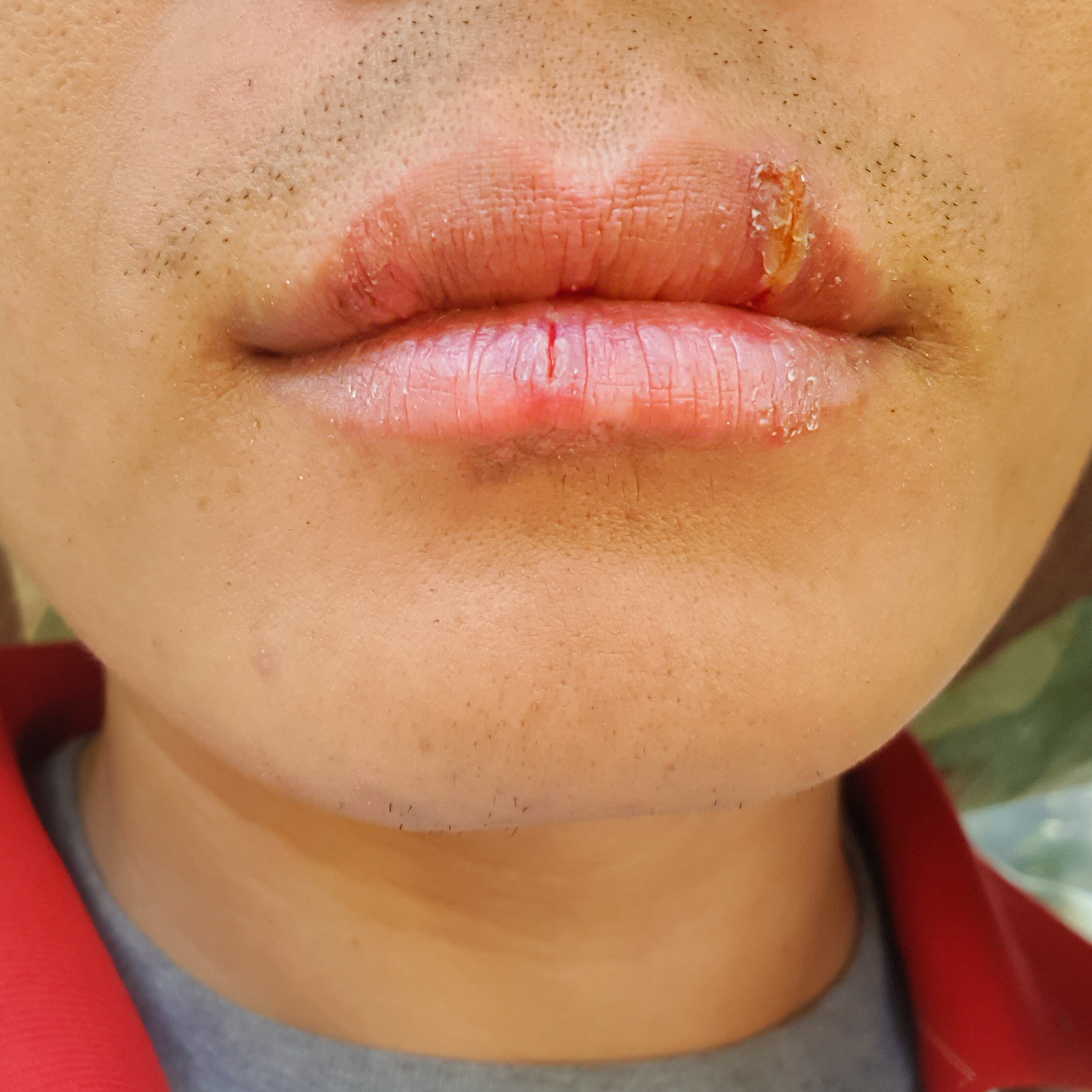 撕嘴皮会让嘴唇变形吗？警惕长期撕嘴皮的危害！