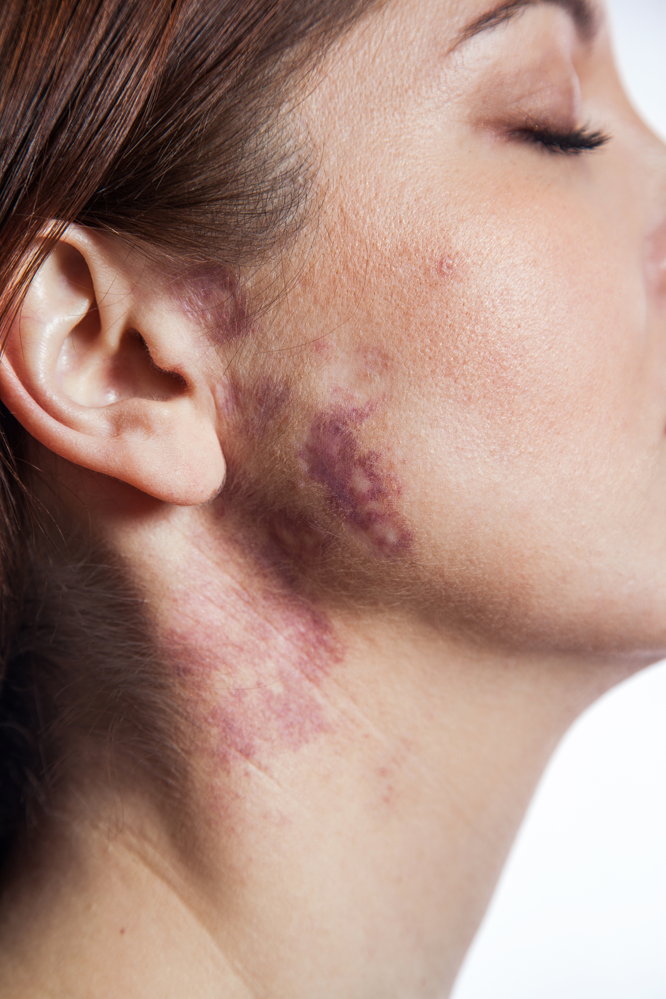 beautiful woman with port-wine stain (birthmark) on her face.