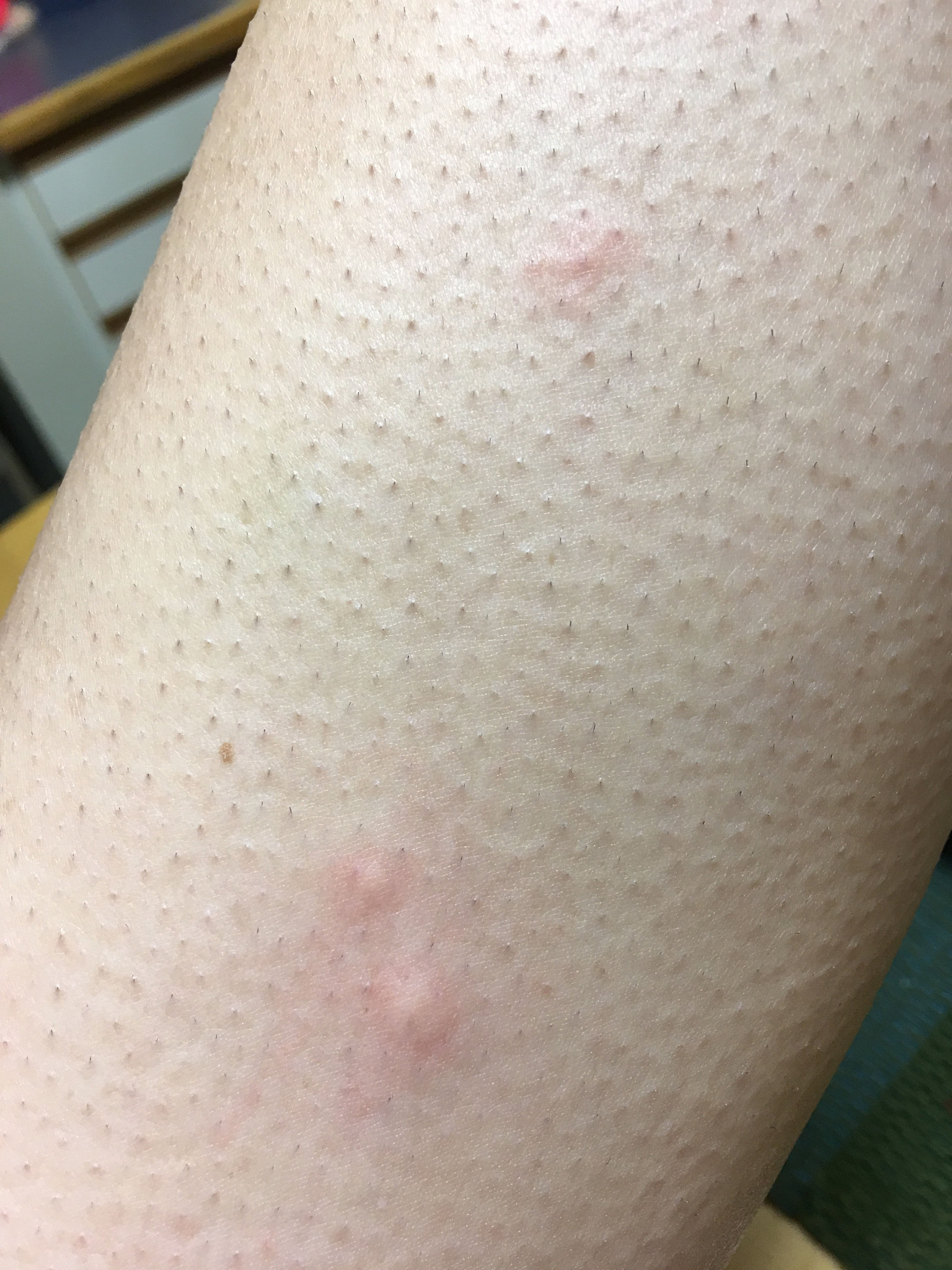 mosquito bites on goose bumped woman's leg