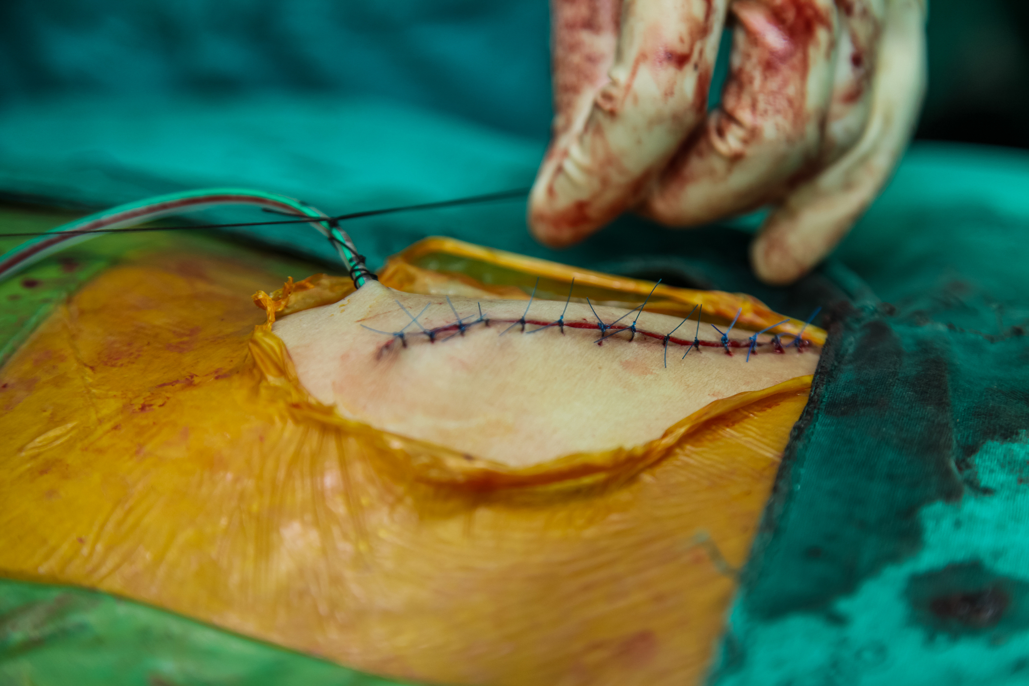 surgeon with patient during surgery to treatment in operating ro