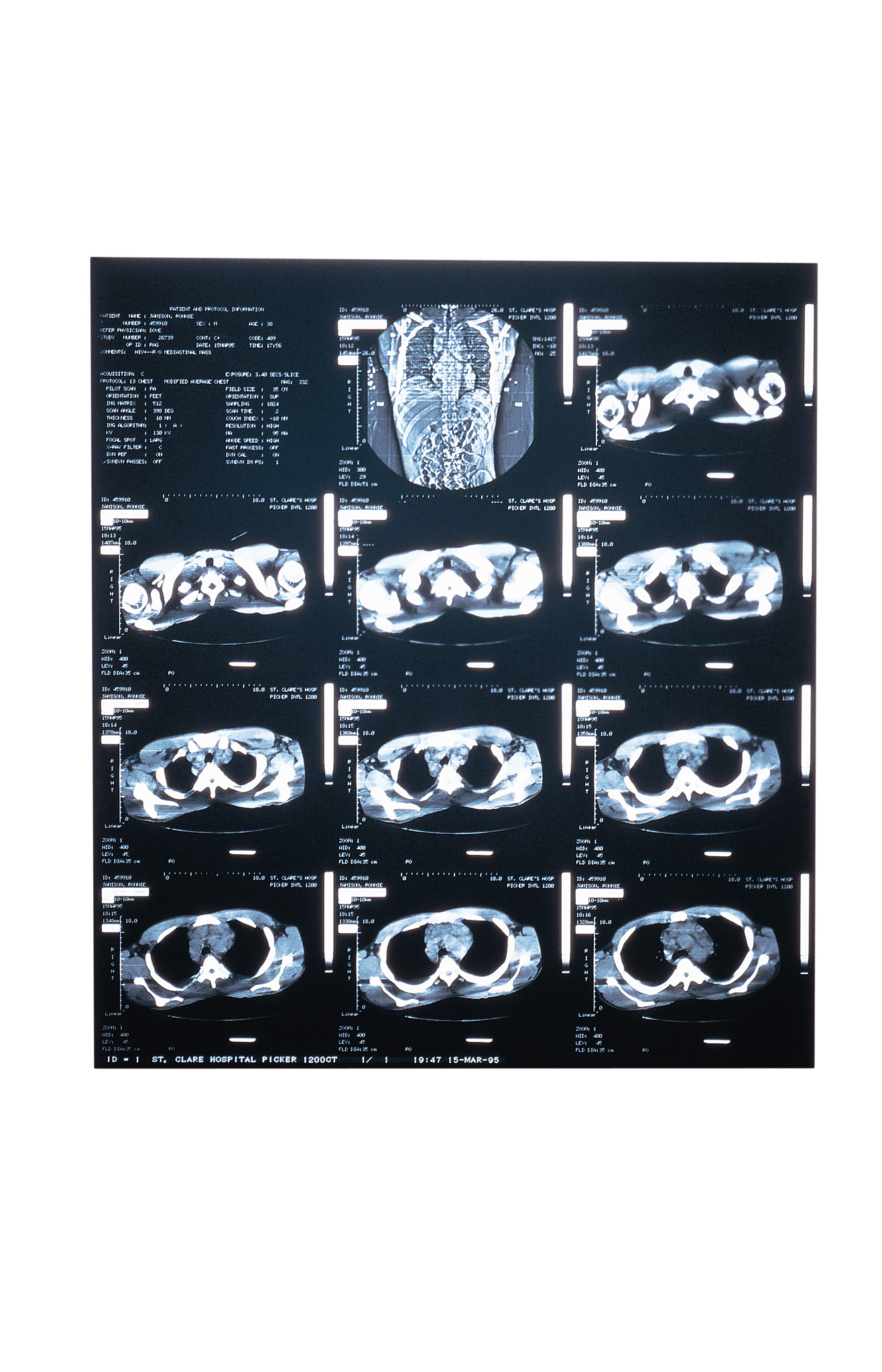 余弦噪声方案在颈椎MRI图像生成中的优势