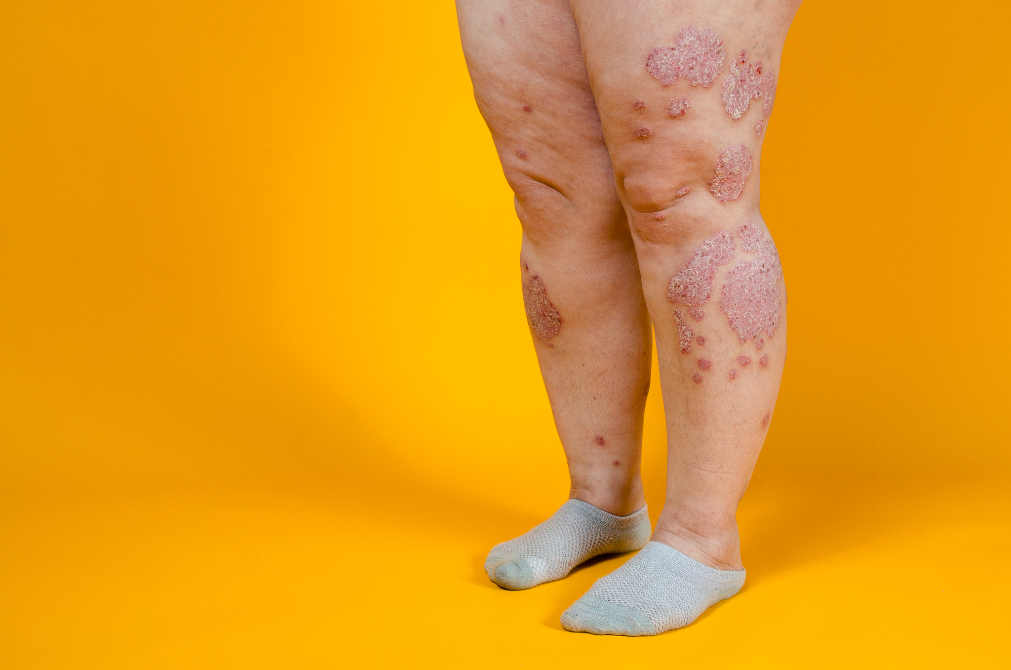 牛皮癣：症状、病因、治疗方法 - 银屑病全方位解析