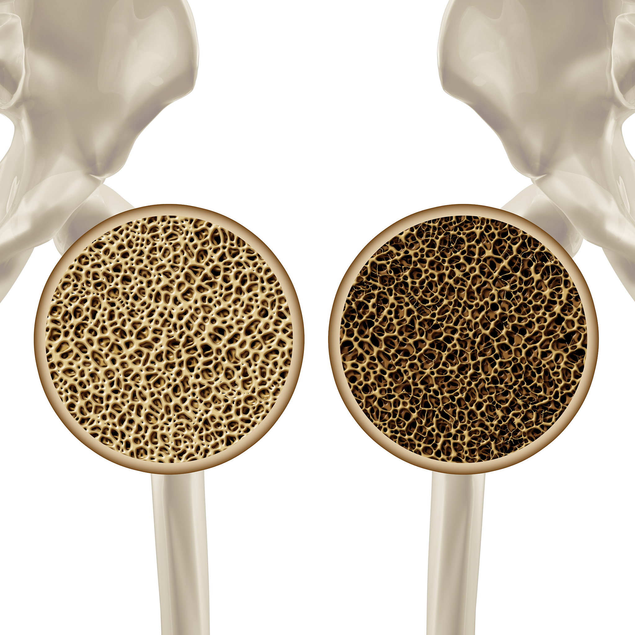 女性骨质疏松：比男性更易患？真相大揭秘！