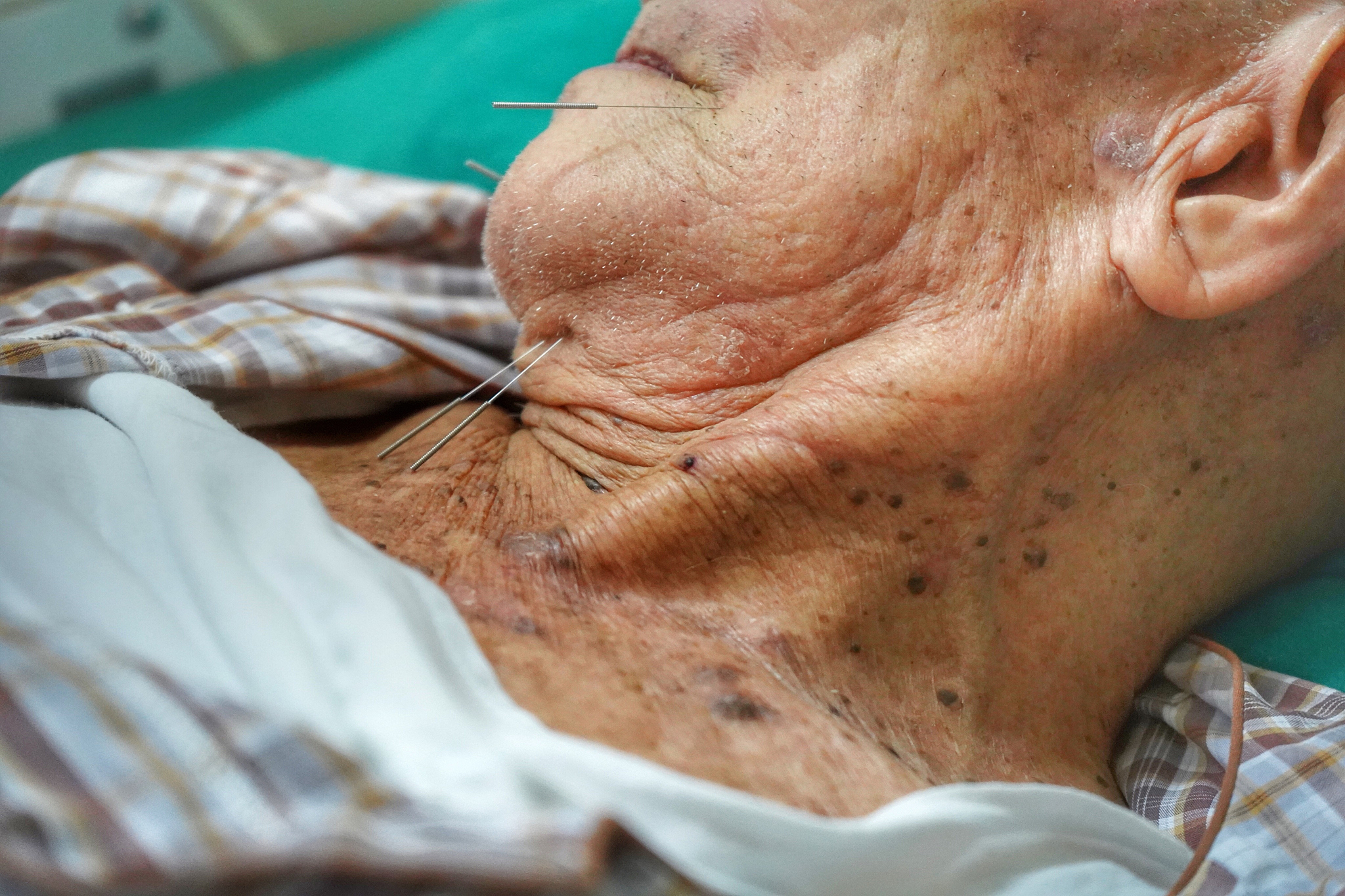 close-up of senior woman with acupuncture needles in face
