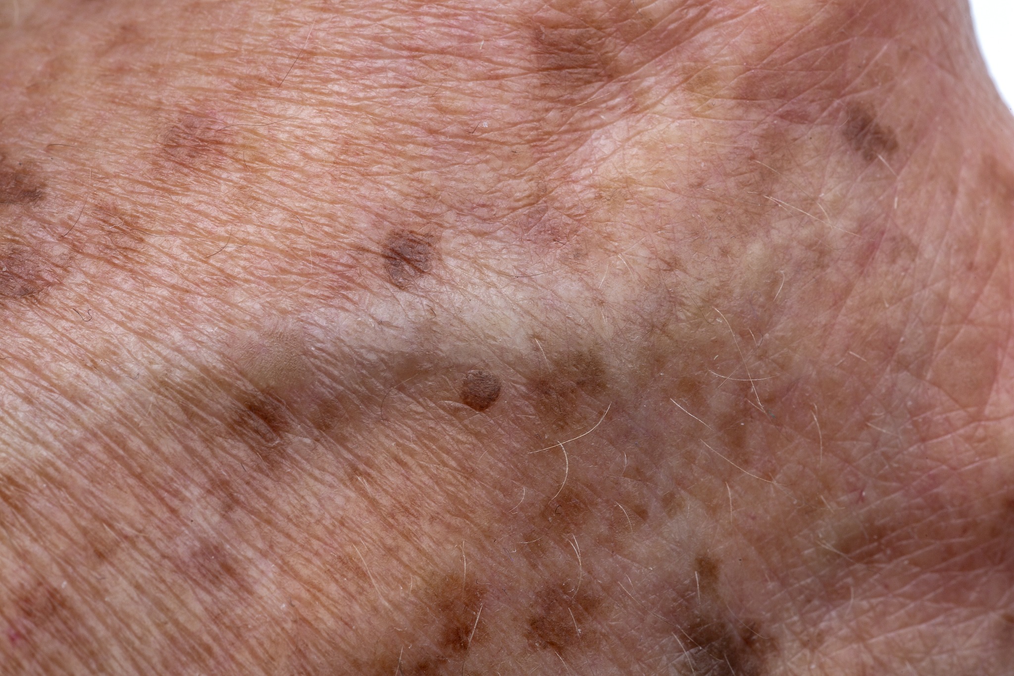 age spots on elderly skin