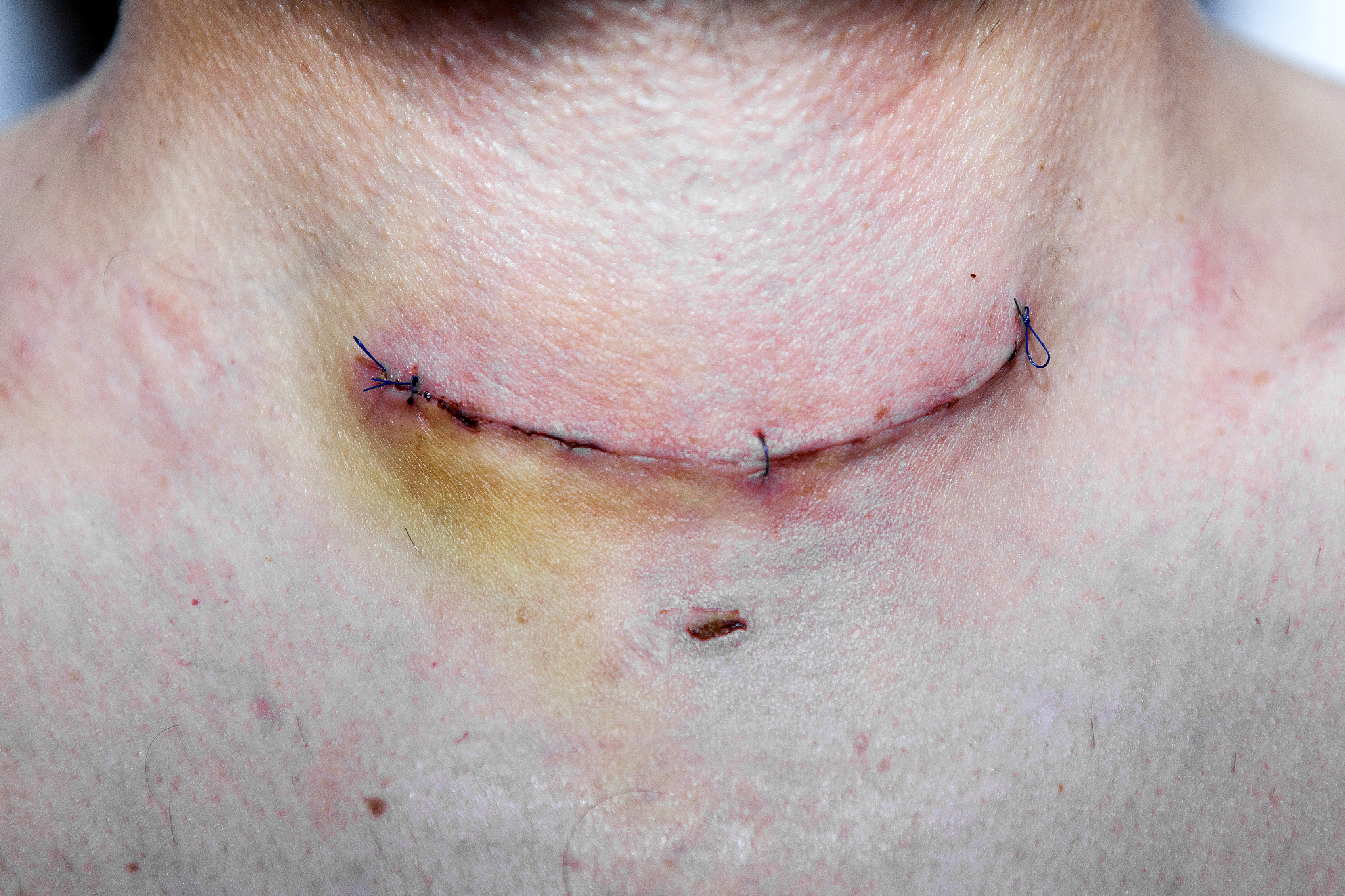 老年巨大甲状腺肿合并甲状腺功能亢：甲状腺切除术治疗优势